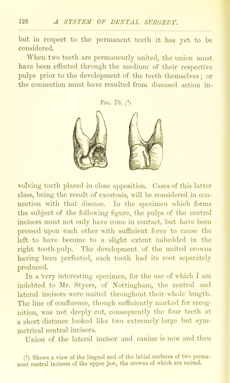 but in respect to the permanent teeth it has yet to be considered. When two teetli are permanently united, the union must have been effected through the medium of their respective pulps prior to the development of the teeth themselves; or the connection must have resulted from diseased action in- FiG. 70. (V volving teeth placed in close apj)Osition. Cases of this latter class, being the result of exostosis, Avill be considered in con- nection with that disease. In the specimen which forms the subject of the following figure, the pulps of the central incisoi's must not only have come in contact, but have been pressed upon eacli other with sufficient force to cause the left to have become to a slight extent imbedded in the right tooth-pulp. The development of the united crowns having been perfected, each tooth had its root separately prodTiced. In a very interesting specimen, for the use of wliich I am indebted to Mr. Stycrs, of Nottingham, the central and lateral incisors were united tln-ouglioiit their whole lengtli. The line of confluence, though sufficiently marked for recog- nition, was not deeply cut, consequently the fo\u- teetli at a short distance looked like two extremely large but sym- metrical central incisors. Union of the lateral incisor and canine is Udw and then (') Shows a view of the lingual and of the labial surfaces of two jienna- nent central incisors of the upper jaw, the crowns of which are united.