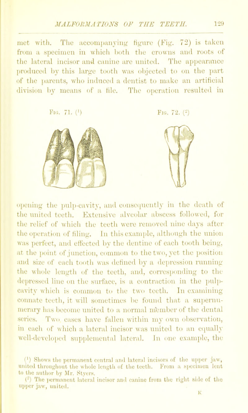 mot witli. Tlie accompaiiyinL;- Huurc (Kiu'. 72) is taken from a .specimen in wliicli l>otli the ei'uwns and roots of the lateral incisor and canine are nnited. Tlie ai)])caraiice jirodneed by tins lar^'e tootii was objected to on tiie ]iart of tlic parents, wiio indnced a dentist to make an artificial division liy means of a file. The operation resulted in Fi.;. 71. (') Fw. 72. (-) opeuinii' tlie pul|i-cavit\', and consei|Uently in tlie death of the united teeth. Ivxtensive alveolar abscess followed, for the relief of which the teeth were removed nine days after the operation of tilin:^-. In this example, altiioui;li the union was ])erfect, and effected by the dentine of eacii tootii bein<i;. at the point of junction, common to the two, yet the po.sition and size of each tooth was detined liy a depression runninj:' the whole leu^'th of the teeth, and, correspondinjj,- to the depressed line on the surface, is a contraction in the pulp- cavity whi(di is connnon to the two teeth. In examining connate teeth, it will sometimes lie tlnuid that a su]>ernu- nierary has become united to a normal member of the dental series. 'I'wo cases have fallen within my own observaticju, ill each of which a lateral incisor was uniteil to an eipially well-(li.'velopeil supplemental lateral. In one example, the I') Slinws tlic periiKincnt ci-iitnil .■mil later.il incisors of the u]iiier j;i\v, united llirou^lidnt llio wliulo length nf tlie teetli. lo-oin ;i s|ieuinieii lent to tlio unllioi- by Mr. Styers. (-') The iierin.-uient lalerul ineisor ;\ii'l ciininc from the right side of the upper jaw, united. K