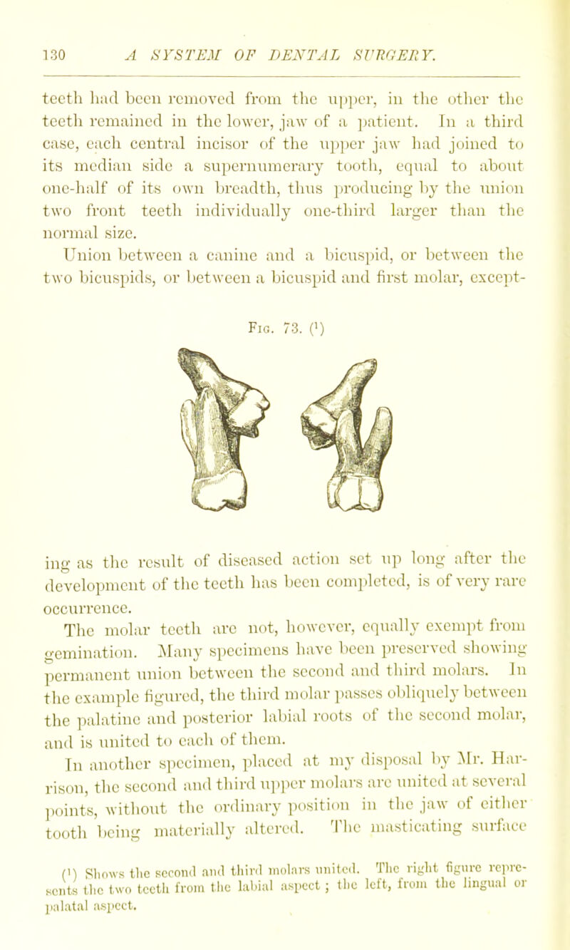 teeth liiul been removed from the iijipcr, in the otlier tlic teeth remained in the lower, jaw of a patient. In a third case, each central incisor of the npper jaw had joined to its median side a supernnmerary tooth, eqtial to abont one-half of its f)wn Ijreadth, thus producing by the union two front teeth individually one-tliird larger than the normal size. Union between a canine and a bicuspid, or between the two bicuspids, or between a bicuspid and first molar, except- Fio. 73. (1) ine as the result of diseased action set up long after tlie development of the teeth lias liccn completed, is of very rare occurrence. The molar teeth are not, however, equally exempt from gemination. ]\Iany specimens have been preserved .showing permanent \niion between the second and third molars. In tlie example figured, the third molar passes obliquely between the palatine and posterior labial roots of the second molar, and is united to each of them. In another specimen, placed at my disposal hj Mr. Har- rison, the second and third ujjper molars are united at several ]ioints, without the ordinary position in the jaw of eitlier tooth being materially altered. The masticating surface (1) Sliows llic second nnd third iiiol:ii-.s united. Tlic right figure repre- sents tlic two tcctli ironi tlic labial aspect ; the left, from the lingual oi- palatal asjicct.