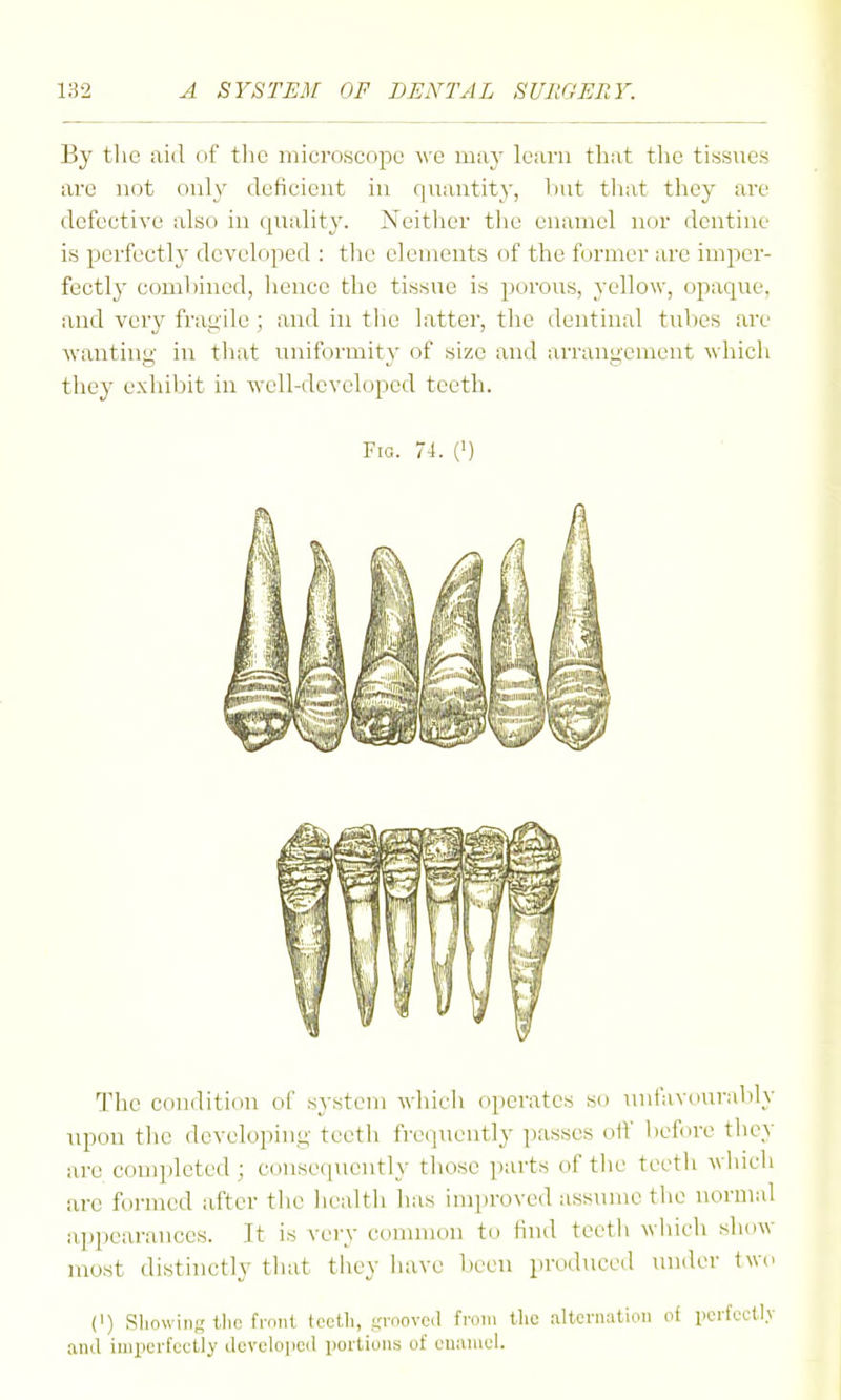 By tlie aid cif tlic microscope we may learn that tlie tissues are not only deficient in quantity, but tiiat they are defective also in quality. Neitlicr tlie enamel nor dentine is perfectly developed : the elements of the former are imper- fectl}- combined, hence the tissue is porous, yellow, opaque, and very fragile ; and in the latter, the dentinal tubes are wanting in that uniformity of size and arrangement which they exhibit in well-developed teeth. Fig. 74. (') The condition of system which operates so unfavoural)ly upon the developing teeth frequently passes off before they are completed; consequently tliose parts of tlie teetli wliicli arc formed after tlic liealtii has improved assume tlie normal appearances. It is very conunon to find tcetli wliieh show most distinctly that they have been produced under two (') Sliowing tlio front tcetli, .uroovca from tlic alternation ot perfectly and imperfectly developed portions of euaiucl.