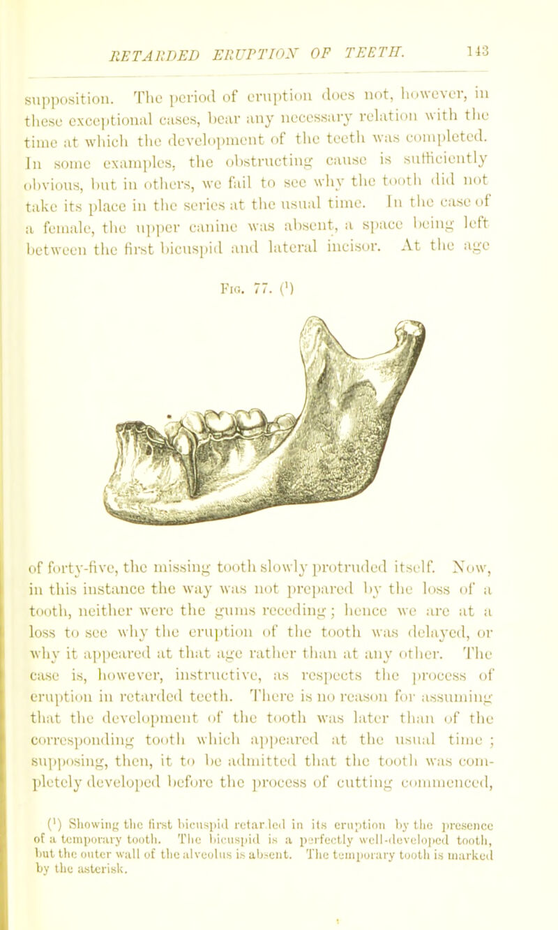 supposition. The period of eruption docs not, however, in tliese exceptional cases, bear any necessary relation with the time at which the development of the teeth was comi)lcted. In some examples, the ohstructinij: cause is sufficiently obvious, but in others, wc fail to sec why the t.ioth did not take its place in the series at the usual time. In tiie case of a female, the upper canine was absent, a s])ace beinj;' left between the first bicuspid and lateral incisor. At the age Fia. 77. (') of forty-five, the mi.ssing tooth slowly ])rotruded itst'lf. Now, in this in.stance the way was not prepared by the loss of a tooth, neither were the gums receding; hence we arc at a loss to see why the eru])tion of the tootli was delayed, or why it ai)peared at that age rather than at any c)ther. 'I'hc case is, however, instructive, as respects the ])rocess of eruption in retarded teeth. There is no reason for assuniing that tlic development of the tooth was later than of the corresponding tootii which ajjpearcd at the usual time ; sujjposing, then, it to be adnutted that the tooth was com- liletely developed before the process of cutting conuuenced, (') Showing t!ic first hicnsiiiil retar led in its cru;itinn hy llio jiresencc of a tomporaiy tootli. The hiciispid is a p'.'rfectly well-(levelo]icd tooth, hut tlu; outer wall of the alveolus is alj-ent. Tlio t'.'niiiurary tootii is marked by the a.sterisk.