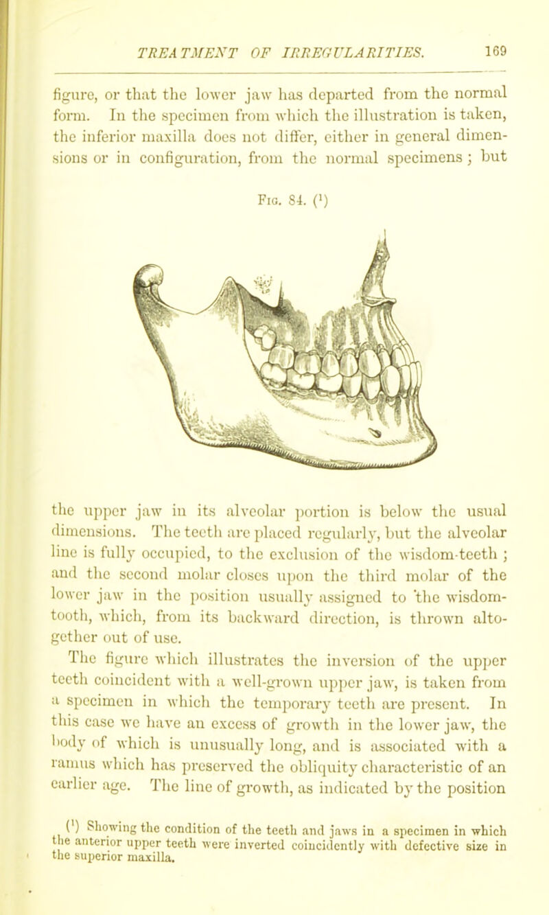 figure, or that the lower jaw has departed from the normal form. In the specimen from wliich the illustration is taken, the inferior maxilla docs not differ, cither in genei-al dimen- sions or in configuration, from the normal specimens ; but Fig. S4. (') the upper jaw in its alveolar portion is below the usual dimensions. The teeth arc placed regularly, but the alveolar line is fully occupied, to the exclusion of the wisdom-teeth ; and the second molar closes upon the third molar of the lower jaw in the position usually assigned to the wusdom- tooth, which, from its backward direction, is thrown alto- gether out of use. The figure which illustrates the inversion of tlie upper teeth coincident with a well-grown upper jaw, is taken from a specimen in wliich the temporary teeth are present. In this case wc liave an excess of growtli in the lower jaw, the liody of which is unusually long, and is associated with a ranuis which has preserved the obliquity characteristic of an earlier age. The line of growth, as indicated by the position (') Showing the condition of the teeth and jaw.s in a specimen in which the anterior upper teeth were inverted coiucidently with defective size in the superior maxilla.