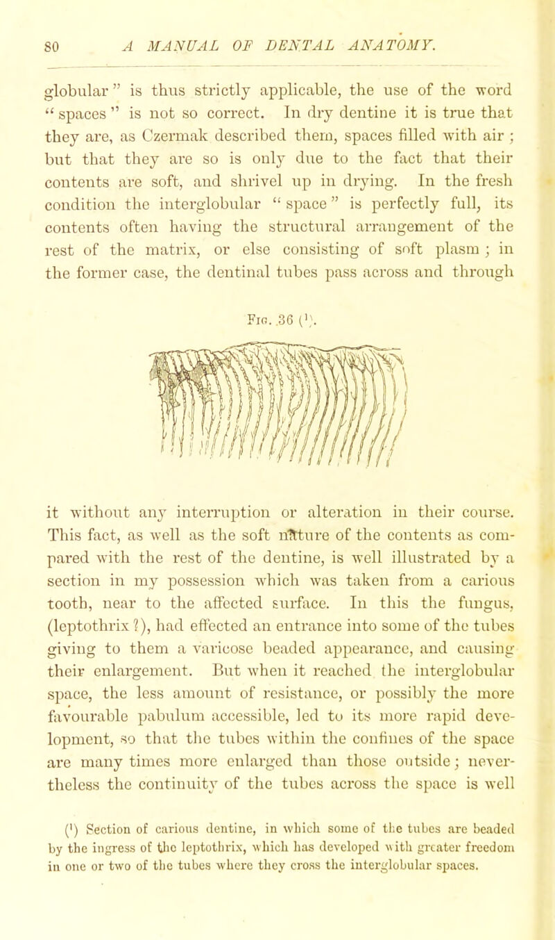 globular ” is thus strictly applicable, the use of the ■word “ spaces ” is not so correct. In dry dentine it is true that they are, as Czermak described them, spaces filled wdth air ; but that they are so is onlj^ dire to the fact that their contents are soft, and shrivel np in drying. In the fresh condition the interglobular “ space ” is perfectly full, its contents often having the structural arrangement of the rest of the matrix, or else consisting of soft plasm ; in the former case, the dentinal tubes pass across and through Fio. ,36 it ■without any interruption or alteration in their course. This fact, as well as the soft nittui'e of the contents as com- pai'ed with the rest of the dentine, is 'well illustrated by a section in my possession w'hich was taken from a carious tooth, near to the affected surface. In this the fungus, (leptothrix 1), had effected an entrance into some of the tubes giving to them a varicose beaded appearance, and causing their enlargement. But ivhen it reached the interglobular space, the less amount of resistance, or possibly the more favourable pabulum accessible, led to its more rapid deve- lopment, so that the tubes within the confines of the space are many times more enlarged than those outside; never- theless the continuity of the tubes across the space is well (') Section of carious dentine, in which some of the tubes are beaded by the ingress of tlic leptothrix, which has developed ^^ith greater freedom in one or two of the tubes where they cro.ss the interglobular spaces.