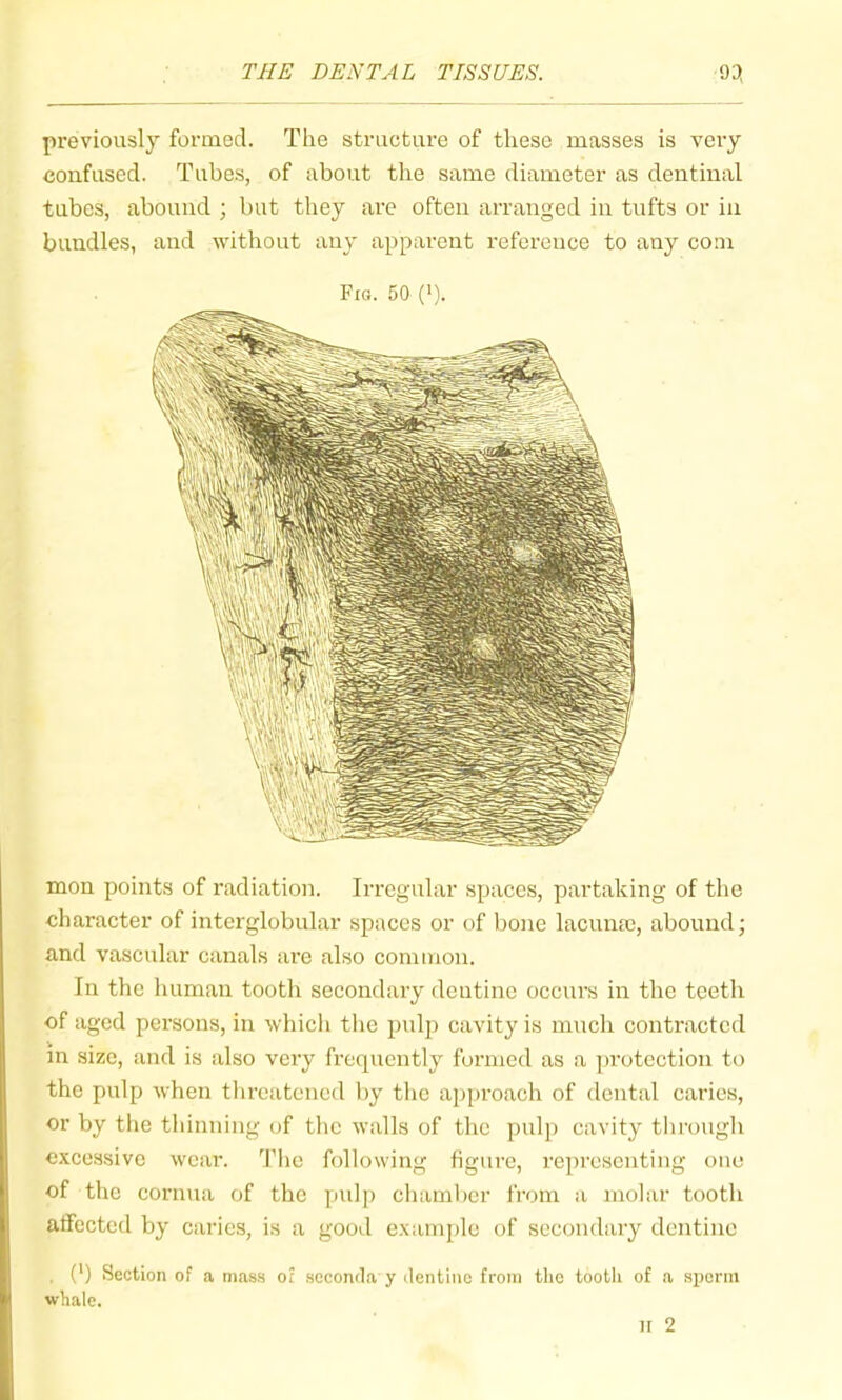 previously formed. The structure of these masses is very confused. Tubes, of about the same diameter as dentinal tubes, abound ; but they arc often arranged in tufts or in bundles, and without any apparent reference to any com Fig. 50 ('). A // t i mon points of radiation. Irregular spaces, partaking of the character of interglobular spaces or of bone lacunm, abound; ' and vascular canals ai'e also common. In the liuman tooth secondary dentine occurs in the teeth of aged persons, in which the pulp cavity is much contracted in size, and is also very freepicntly formed as a ])rotection to the jHilp when tlireatcncd by the approach of dental caries, or by the thinning of tlic walls of the pulp cavity through excessive wear, d’lic following figure, re])rcscnting one of the cornua of the pulp chaml)cr I'rom a molar tooth affected by caries, is a good e.xample of secondary dentine (') Section of a mass of .seconda y dentine from the tooth of a si)onu whale.