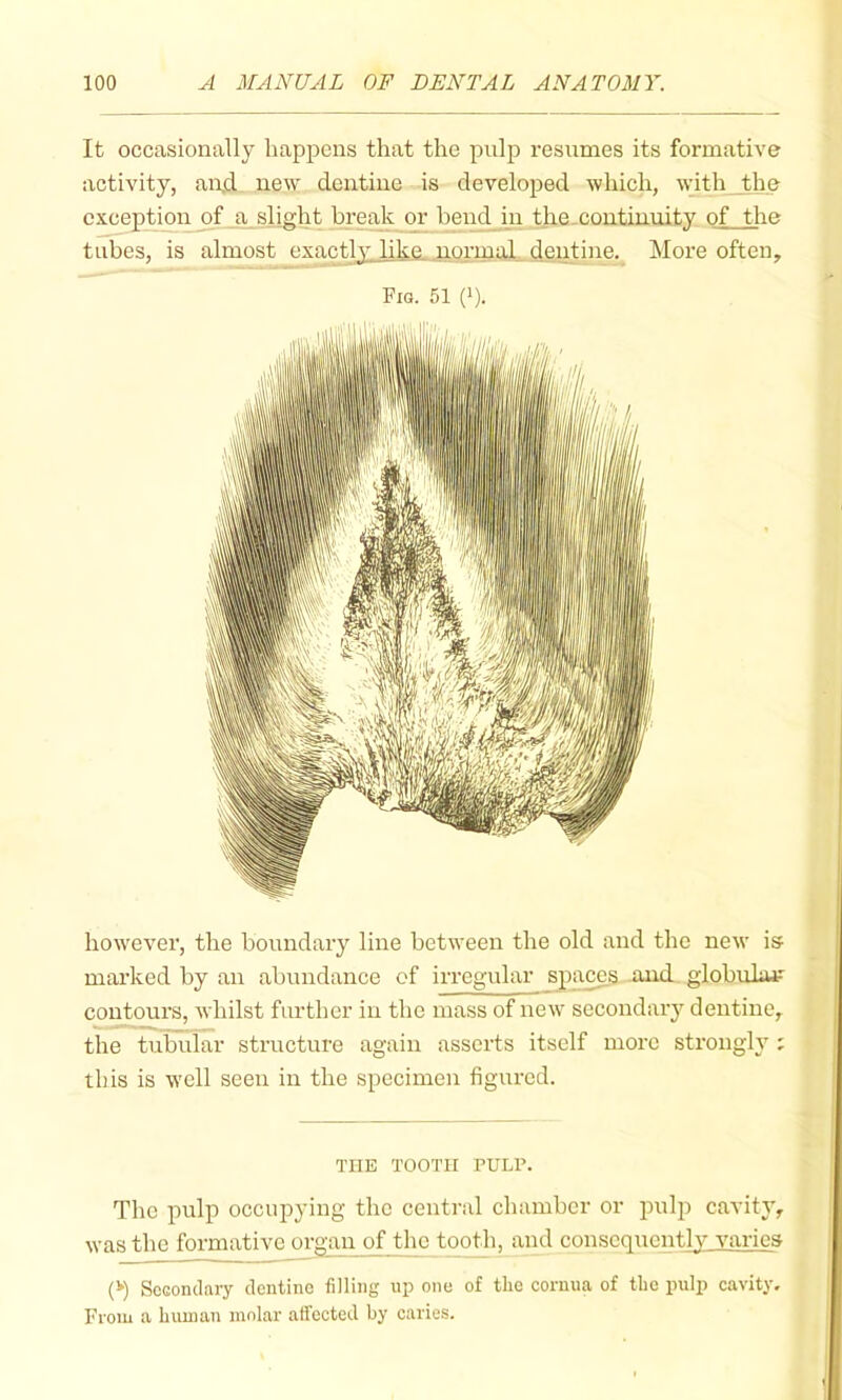 It occasionally happens that the pulp resumes its formative activity, an,d new dentine is developed which, wdthjthe exception of ji^slight break or beud_m the-continuity of the tubes, is almost exacUy like normal dentine. More often. Fia. 51 (1). however, the boundary line between the old and the new is marked by an abundance of irregular ^jpa^s and globuliu? contours, whilst further in the mass of new secondaiy dentine, the tubular structure again asserts itself more strongly ; this is W'ell seen in the specimen figured. THE TOOTH PULP. The pulp occupying the central chamber or pulp cavity, was the formative m-gan of the tooth, and consequently varies {‘) Scsondary dentine filling up one of tlio cornua of the pulp cavity. From a human molar affected by caries.