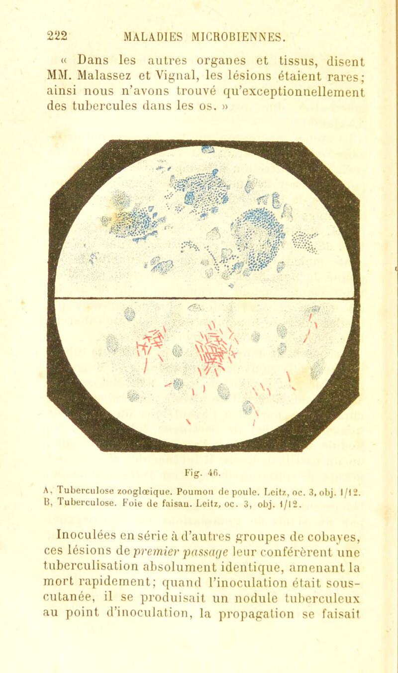 « Dans les autres organes et tissus, disent MM. Malassez et Vigual, les lésions étaient rares; ainsi nous n'avons trouvé qu'exceptionnellement des tubercules dans les os. » Fig. 4fl. A, Tubeixulose zonglœique. Poumon de poule. Lcitz, oc. 3, obj. 1/12. 13, Tuberculose. Foie de faisan. Leitz, oc. 3, obj. )/l2. Inoculées en série à d'autres groupes de cobayes, ces lésions de premier passage leur conférèrent une tuberculisation absolument identique, amenant la mort rapidement; quand l'inoculation était sous- cutanée, il se produisait un nodule tuberculeux au point d'inoculation, la propagation se faisait