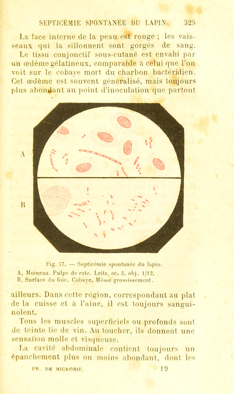 La face inlorne de la peau est rouge ; les vais- seaux qui la sillounenl sont gorgés de sang. Le tissu coujonctif sous-cutané est envahi par un œdème gélatineux, comparable à celui que l'on voit sur le cobaye mort du charbon bactéridien. Cet œdètnc est souvent généralisé, mais toujours plus abondant au imint d'inoculation que partout A Kig. .S7. — Septicémie spoutiinoe du lupin. A, Moineau. Pulpe de rnto. Loilz, oc. 3, obj. 1/12. B, .Surface lUi foie. Cohiiye. Même grossissement. ailleurs. Dans cotte région, correspondant au plat de la cuisse et à l'aine, il est toujours sangui- nolent. Tous les muscles superricicls ou profonds sont de teinte lie de vin. Au loucher, ils donnent une sensation molle et vis(|ueuse. L;i cavité abdominale contient toujours un épanchement i)lus ou moins abonilant, dont les