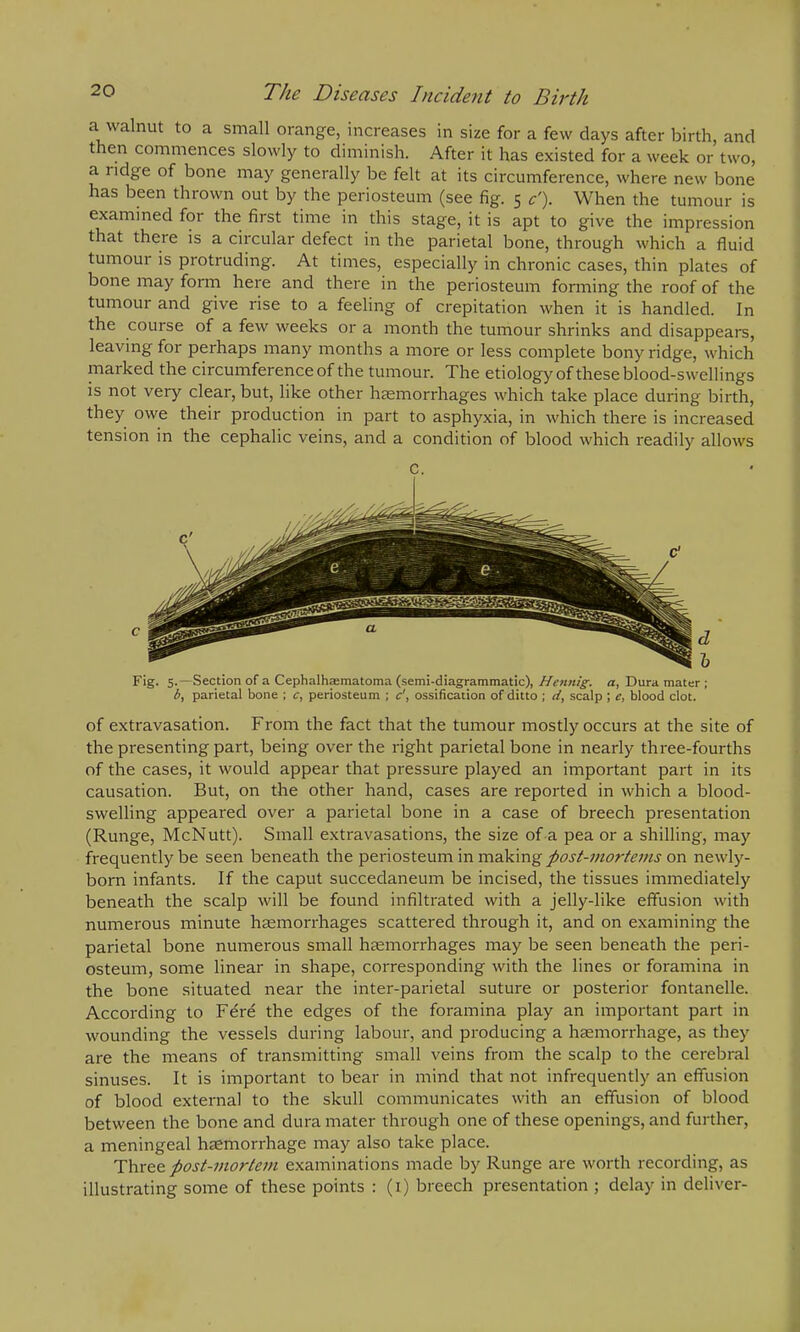 a walnut to a small orange, increases in size for a few days after birth, and then commences slowly to diminish. After it has existed for a week or two, a ridge of bone may generally be felt at its circumference, where new bone has been thrown out by the periosteum (see fig. 5 c'). When the tumour is examined for the first time in this stage, it is apt to give the impression that there is a circular defect in the parietal bone, through which a fluid tumour is protruding. At times, especially in chronic cases, thin plates of bone may form here and there in the periosteum forming the roof of the tumour and give rise to a feeling of crepitation when it is handled. In the course of a few weeks or a month the tumour shrinks and disappears, leaving for perhaps many months a more or less complete bony ridge, which marked the circumference of the tumour. The etiology of these blood-swellings is not very clear, but, like other haemorrhages which take place during birth, they owe their production in part to asphyxia, in which there is increased tension in the cephalic veins, and a condition of blood which readily allows C. Fig. 5.—Section of a Cephalhematoma (semi-diagrammatic), Hennig. a, Dura mater ; b, parietal bone ; c, periosteum ; c', ossification of ditto ; d, scalp; e, blood clot. of extravasation. From the fact that the tumour mostly occurs at the site of the presenting part, being over the right parietal bone in nearly three-fourths of the cases, it would appear that pressure played an important part in its causation. But, on the other hand, cases are reported in which a blood- swelling appeared over a parietal bone in a case of breech presentation (Runge, McNutt). Small extravasations, the size of a pea or a shilling, may frequently be seen beneath the periosteum in making post-mortems on newly- born infants. If the caput succedaneum be incised, the tissues immediately beneath the scalp will be found infiltrated with a jelly-like effusion with numerous minute haemorrhages scattered through it, and on examining the parietal bone numerous small haemorrhages may be seen beneath the peri- osteum, some linear in shape, corresponding with the lines or foramina in the bone situated near the inter-parietal suture or posterior fontanelle. According to Fere the edges of the foramina play an important part in wounding the vessels during labour, and producing a haemorrhage, as they are the means of transmitting small veins from the scalp to the cerebral sinuses. It is important to bear in mind that not infrequently an effusion of blood externa] to the skull communicates with an effusion of blood between the bone and dura mater through one of these openings, and further, a meningeal haemorrhage may also take place. Three post-mortem examinations made by Runge are worth recording, as illustrating some of these points : (1) breech presentation ; delay in deliver-