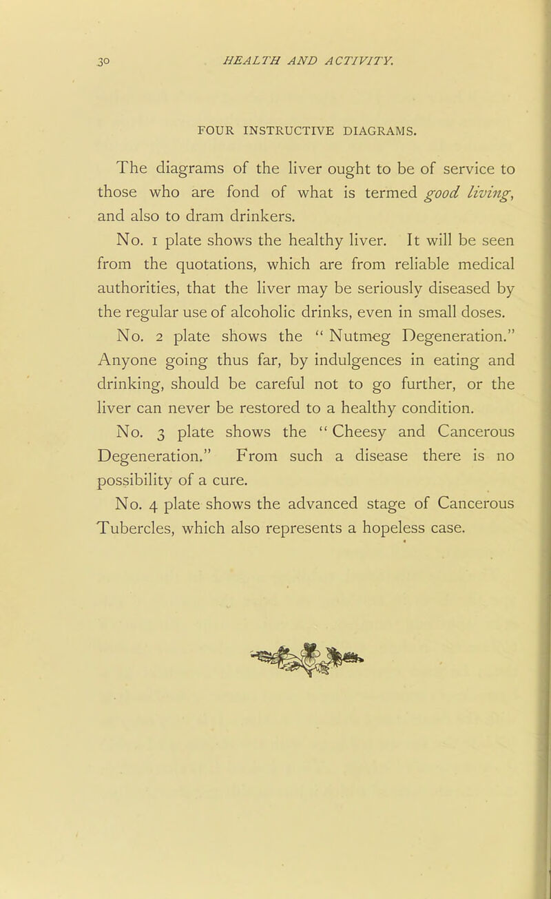 FOUR INSTRUCTIVE DIAGRAMS. The diagrams of the liver ought to be of service to those who are fond of what is termed good living, and also to dram drinkers. No. i plate shows the healthy liver. It will be seen from the quotations, which are from reliable medical authorities, that the liver may be seriously diseased by the regular use of alcoholic drinks, even in small doses. No. 2 plate shows the  Nutmeg Degeneration. Anyone going thus far, by indulgences in eating and drinking, should be careful not to go further, or the liver can never be restored to a healthy condition. No. 3 plate shows the  Cheesy and Cancerous Degeneration. From such a disease there is no possibility of a cure. No. 4 plate shows the advanced stage of Cancerous Tubercles, which also represents a hopeless case.