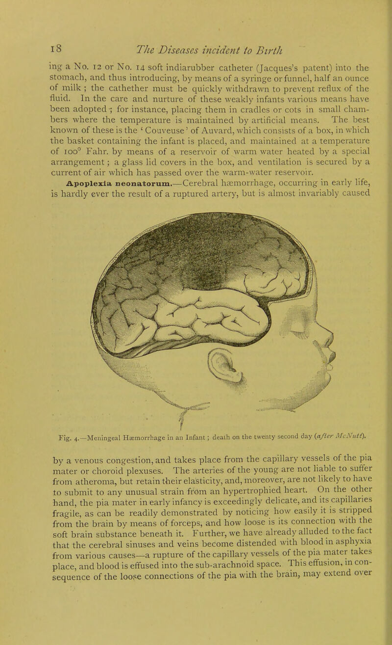 ing a No. 12 or No. 14 soft indianibber catheter (Jacques’s patent) into the stomach, and thus introducing, by means of a syringe or funnel, half an ounce of milk ; the cathether must be quickly withdrawn to prevent reflux of the fluid. In the care and nurture of these weakly infants various means have been adopted •; for instance, placing them in cradles or cots in small cham- bers where the temperature is maintained by artificial means. The best known of these is the ‘ Couveuse’ of Auvard, which consists of a box, in which the basket containing the infant is placed, and maintained at a temperature of 100° Fahr. by means of a reservoir of warm water heated by a special arrangement; a glass lid covers in the box, and ventilation is secured by a current of air which has passed over the warm-water reservoir. Apoplexla neonatorum.—Cerebral hemorrhage, occurring in early life, is hardly ever the result of a ruptured artery, but is almost invariably caused Fig. 4.—Meningeal Hemorrhage in an Infant; death on the twenty second day (after McNutC), by a venous congestion, and takes place from the capillary vessels of the pia mater or choroid plexuses. The arteries of the young are not liable to suffer from atheroma, but retain their elasticity, and, moreover, are not likely to have to submit to any unusual strain from an hypertrophied heart. On the other hand, the pia mater in early infancy is e.xceedingly delicate, and its capillaries fragile, as can be readily demonstrated by noticing how easily it is stripped from the brain by means of forceps, and how loose is its connection with the soft brain substance beneath it. Further, we have already alluded to the fact that the cerebral sinuses and veins become distended with blood in asphyxia from various causes—a rupture of the capillary vessels of the pia mater takes place, and blood is effused into the sub-arachnoid space. This effusion, in con- sequence of the loose connections of the pia with the brain, may extend o^ er