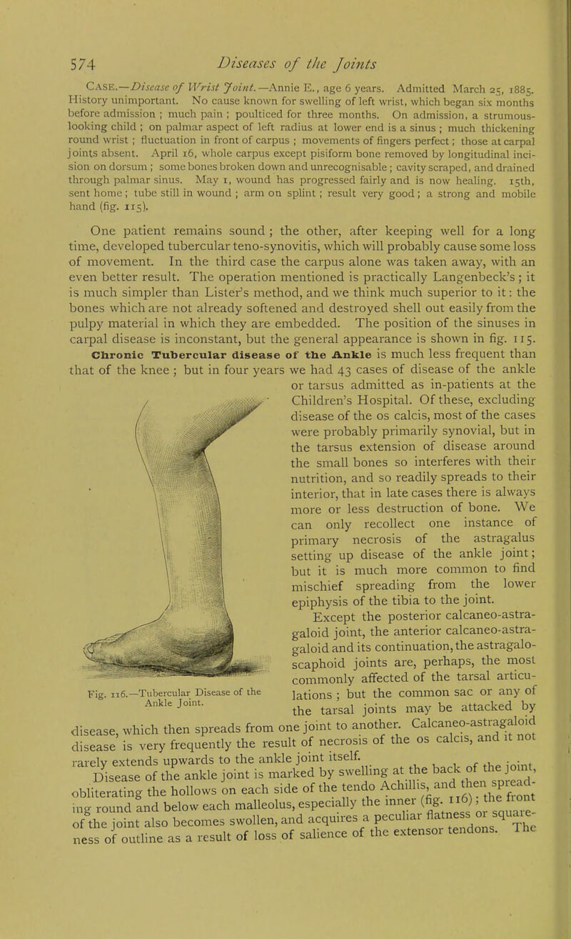 Cask.—0/PFWj/Annie E., age 6 years. Admitted March 25, 1885. History unimportant. No cause known for swelling of left wrist, which began si.x months before admission ; much pain ; poulticed for three months. On admission, a strumous- looking child : on palmar aspect of left radius at lower end is a sinus ; much thickening round wrist ; fluctuation in front of carpus ; movements of fingers perfect; those at carpal joints absent. April 16, whole carpus except pisiform bone removed by longitudinal inci- sion on dorsum ; some bones broken down and unrecognisable; cavity scraped, and drained through palmar sinus. May i, wound has progressed fairly and is now healing. 15th, sent home; tube still in wound ; arm on splint ; result very good; a strong and mobile hand (fig. 115). One patient remains sound ; the other, after keeping well for a long time, developed tubercular teno-synovitis, which will probably cause some loss of movement. In the third case the carpus alone was taken away, with an even better result. The operation mentioned is practically Langenbeck’s; it is much simpler than Lister’s method, and we think much superior to it; the bones which are not already softened and destroyed shell out easily from the pulpy material in which they are embedded. The position of the sinuses in carpal disease is inconstant, but the general appearance is shown in fig. 115. Cbronic Tubercular disease of the .A.nkle is much less frequent than that of the knee ; but in four years we had 43 cases of disease of the ankle or tarsus admitted as in-patients at the Children’s Hospital. Of these, excluding disease of the os calcis, most of the cases were probably primarily synovial, but in the tarsus extension of disease around the small bones so interferes with their nutrition, and so readily spreads to their interior, that in late cases there is always more or less destruction of bone. We can only recollect one instance of primary necrosis of the astragalus setting up disease of the ankle joint; but it is much more common to find mischief spreading from the lower epiphysis of the tibia to the joint. Except the posterior calcaneo-astra- galoid joint, the anterior calcaneo-astra- galoid and its continuation, the astragalo- scaphoid joints are, perhaps, the most commonly affected of the tarsal articu- lations ; but the common sac or any of the tarsal joints may be attacked by disease, which then spreads from one joint to another disease is very frequently the result of necrosis of the os calcis, and rarely extends upwards to the ankle joint itself. mint Disease of the ankle joint is marked by swelling at the obliterating the hollows on each side of the tendo ing round and below each malleolus, especially the inner (fig. 116) ^^on - -e joint also becomes swollen, and acquires a peculiar flatness or squaie of outline as a result of loss of salience of the extensor tendons. The Fig. 116.—Tubercular Disease of the Ankle Joint. ness