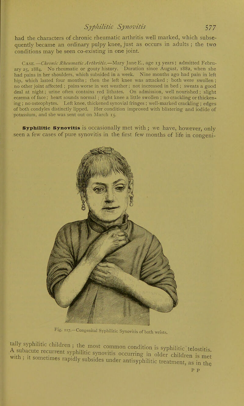 had the characters of chronic rheumatic arthritis well marked, which subse- quently became an ordinary pulpy knee, just as occurs in adults ; the two conditions may be seen co-existing in one joint. Case.—Chronic Rheumatic Arthritis.—Mary JaneE., age 13 years; admitted Febru- ary 25, 1884. No rheumatic or gouty history. Duration since August, 1882, when she had pains in her shoulders, which subsided in a week. Nine months ago had pain in left hip, which lasted four months ; then the left knee was attacked ; both were swollen; no other joint affected ; pains worse in wet weather ; not increased in bed ; sweats a good deal at night; urine often contains red lithates. On admission, well nourished; slight eczema of face; heart sounds normal ; right knee a little swollen ; no crackling or thicken- ing : no osteophytes. Left knee, thickened synovial fringes ; well-marked crackling ; edges, of both condyles distinctly lipped. Her condition improved with blistering and iodide of potassium, and she was sent out on March 15. Syphilitic Synovitis is occasionally met with ; we have, however, only seen a few cases of pure synovitis in the first few months of life in congeni- Fig. ii7.-Congenital Syphilitic Synovitis of both wrists. children ; the most common condition is syphilitic”telostitis jacute recurrent syphilitic synovitis occurring in older children is mor with ; It sometimes rapidly subsides under antisy,fhilitic treat^^nTg inThe P P