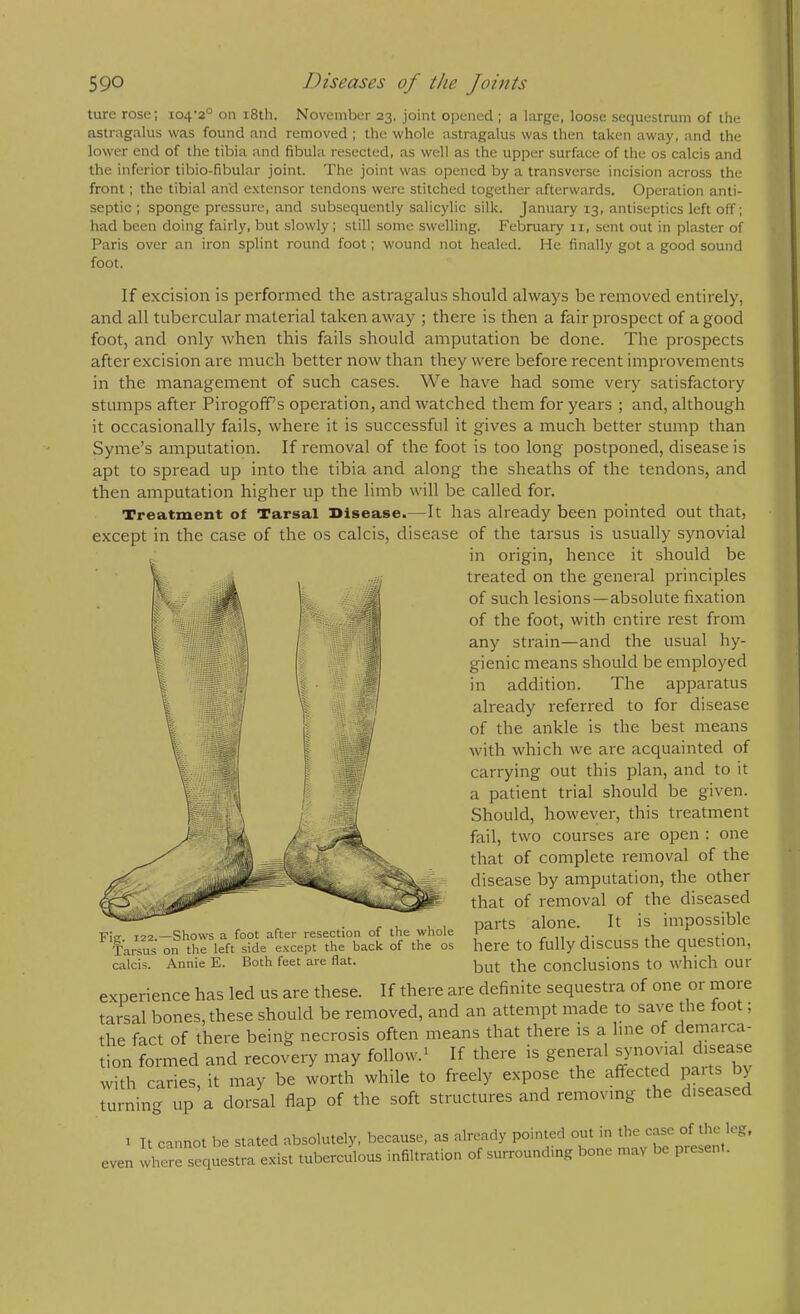 ture rose; i04'2° on i8th. November 23, joint opened ; a large, loose sequestrum of the astragalus was found and removed ; the whole astragalus was then taken away, and the lower end of the tibia and fibula resected, as well as the upper surface of the os calcis and the inferior tibio-fibular joint. The joint was opened by a transverse incision across the front; the tibial and e.xtensor tendons were stitched together afterwards. Operation anti- septic ; sponge pressure, and subsequently salicylic silk. January 13, antiseptics left off; had been doing fairly, but slowly; still some swelling. February ii, sent out in plaster of Paris over an iron splint round foot; wound not healed. He finally got a good sound foot. If excision is performed the astragalus should always be removed entirely, and all tubercular material taken away ; there is then a fair prospect of a good foot, and only when this fails should amputation be done. The prospects after excision are much better now than they were before recent improvements in the management of such cases. We have had some very satisfactory stumps after Pirogoff’s operation, and watched them for years ; and, although it occasionally fails, where it is successful it gives a much better stump than Syme’s amputation. If removal of the foot is too long postponed, disease is apt to spread up into the tibia and along the sheaths of the tendons, and then amputation higher up the limb will be called for. Treatment of Tarsal Disease.—It has already been pointed out that, except in the case of the os calcis, disease of the tarsus is usually synovial bcc led are these. If there are definite sequestra of one or more Fig. 122.—1 ig. 122.—Shows a foot after resection of the whole Tarsus on the left side e.\cept the back of the os calcis. Annie E. Both feet are flat. in origin, hence it should be treated on the general principles of such lesions—absolute fixation of the foot, with entire rest from any strain—and the usual hy- gienic means should be employed in addition. The apparatus already referred to for disease of the ankle is the best means with which we are accjuainted of carrying out this plan, and to it a patient trial should be given. Should, however, this treatment fail, two courses are open : one that of complete removal of the disease by amputation, the other that of removal of the diseased parts alone. It is impossible here to fully discuss the question, but the conclusions to which our