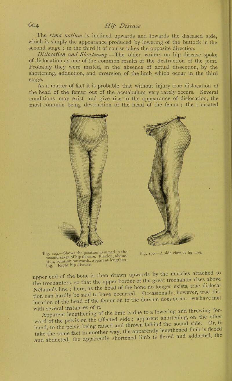 The rima natium is inclined upwards and towards the diseased side, which is simply the appearance produced by lowering of the buttock in the second stage ; in the third it of course takes the opposite direction. Dislocation and Shortening.—The older writers on hip disease spoke of dislocation as one of the common results of the destruction of the joint. Probably they were misled, in the absence of actual dissection, by the shortening, adduction, and inversion of the limb which occur in the third stage. As a matter of fact it is probable that without injury true dislocation of the head of the femur out of the acetabulum very rarely occurs. Several conditions may exist and give rise to the appearance of dislocation, the most common being destruction of the head of the femur; the truncated Fie. 120.—Shows the position assumed in the j,-- side view of fig. 129. second stage of hip disease. Flexion, abduc- tion, rotation outwards, apparent lengthen- ing. Right hip disease. UDoer end of the bone is then drawn upwards by the muscles adached to th^e trochanters, so that the upper border of the great trochanter rises above Nelaton’s line ; here, as the head of the bone no longer exists, true disloca- tion can hardly be said to have occurred. Occasionally, however, true is- “cation of the head of the femur on to the dorsum does occur_we have met ArnTrentTengthening of the limb is due to a lowering and throwing for- wardTthe peTvfs on th! affected side ; apparent shortening on the other hand to the^lvis being raised and thrown behind the sound side. Or, take the same fact in another way, the apparently lengthened Innb is flexed Ind abducted, the apparently shortened limb is flexed and adducted, the