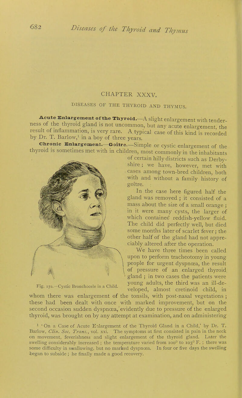 <582 Diseases of the Thyroid and Thymus CHAPTER XXXV, DISEASES OF THE THYROID AND THYMUS. Acute Enlargement of the Thyroid.—A slight enlargement with tender- ness of the thyroid gland is not uncommon, but any acute enlargement the result of inflammation, is very rare. A typical case of this kind is recorded by Dr. T. Barlow,^ in a boy of three years. Chronic Enlarg^ement. Goitre.—Simple or cystic enlargement of the thyioid is sometimes met with in children, most commonly in the inhabitants of certain hilly districts such as Derby- shire ; we have, however, met with cases among town-bred children, both with and without a family history of goitre. In the case here figured half the gland was removed ; it consisted of a mass about the size of a small orange ; in it were many cysts, the larger of which contained reddish-yellow fluid. The child did perfectly well, but died some months later of scarlet fever; the other half of the gland had not appre- ciably altered after the operation. We have three times been called upon to perform tracheotomy in young people for urgent dyspnoea, the result of pressure of an enlarged thyroid gland ; in two cases the patients were ^ . „ , , . . young adults, the third was an ill-de- ^ig. 172.—Cystic Bronchocele in a Child. , , , • • i i • velopedj almost cretinoid childj m whom there was enlargement of the tonsils, with post-nasal vegetations ; these had been dealt with once with mai'ked improvement, but on the second occasion sudden dyspnoea,”evidently due to pressure of the enlai'ged thyroid, was brought on by any attempt at examination, and on administering 1 ‘ On a Case of Acute Enlargement of the Thyroid Gland in a Child,' by Dr. T. Barlow, Clin. Soc, Trans., vol. xxi. The symptoms at first consisted in pain in the neck on movement, feverishness and slight enlargement of the thyroid gland. Later the swelling considerably increased ; the temperature varied from ioo° to 103° F. ; there was some difficulty in swallowing, but no marked dyspnoea. In four or five days the swelling began to subside ; he finally made a good recovery.