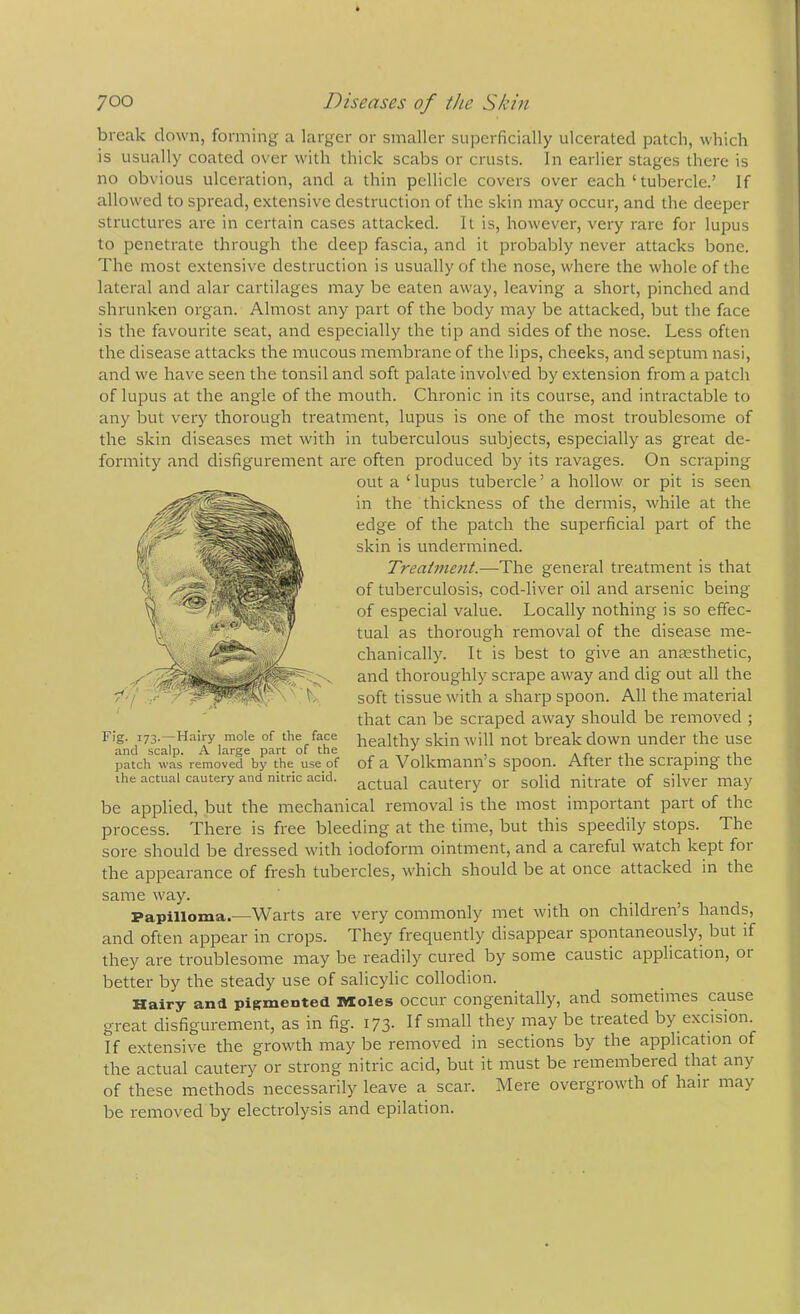 break clown, forming a larger or smaller superficially ulcerated patch, which is usually coated over with thick scabs or crusts. In earlier stages there is no obvious ulceration, and a thin pellicle covers over each ‘ tubercle.’ If allowed to spread, extensive destruction of the skin may occur, and the deeper structures are in certain cases attacked. It is, however, very rare for lupus to penetrate through the deep fascia, and it probably never attacks bone. The most extensive destruction is usually of the nose, where the whole of the lateral and alar cartilages may be eaten away, leaving a short, pinched and shrunken organ. Almost any part of the body may be attacked, but the face is the favourite seat, and especially the tip and sides of the nose. Less often the disease attacks the mucous membrane of the lips, cheeks, and septum nasi, and we have seen the tonsil and soft palate involved by extension from a patch of lupus at the angle of the mouth. Chronic in its course, and intractable to any but very thorough treatment, lupus is one of the most troublesome of the skin diseases met with in tuberculous subjects, especially as great de- formity and disfigurement are often produced by its ravages. On scraping out a ‘ lupus tubercle ’ a hollow or pit is seen in the thickness of the dermis, while at the edge of the patch the superficial part of the skin is undermined. Treat7nent.—-The general treatment is that of tuberculosis, cod-liver oil and arsenic being of especial value. Locally nothing is so effec- tual as thorough removal of the disease me- chanically. It is best to give an anaesthetic, and thoroughly scrape away and dig out all the soft tissue with a sharp spoon. All the material that can be scraped away should be removed ; healthy skin will not break down under the use of a Volkmann’s spoon. After the scraping the actual cautery or solid nitrate of silver may be applied, but the mechanical removal is the most important part of the process. There is free bleeding at the time, but this speedily stops. The sore should be dressed with iodoform ointment, and a careful watch kept foi the appearance of fresh tubercles, which should be at once attacked in the same way. Papilloma.—Warts are very commonly met with on children’s hands, and often appear in crops. They frequently disappear spontaneously, but if they are troublesome may be readily cured by some caustic application, or better by the steady use of salicylic collodion. Hairy and pigmented Moles occur congenitally, and sometimes cause great disfigurement, as in fig. 173. If small they may be treated by excision. If extensive the growth may be removed in sections by the application of the actual cautery or strong nitric acid, but it must be remembered that any of these methods necessarily leave a scar. Mere overgrowth of hair may be removed by electrolysis and epilation. Fig. 173.—Hairy mole of the face and scalp. A large part of the patch was removed by the use of the actual cautery and nitric acid.