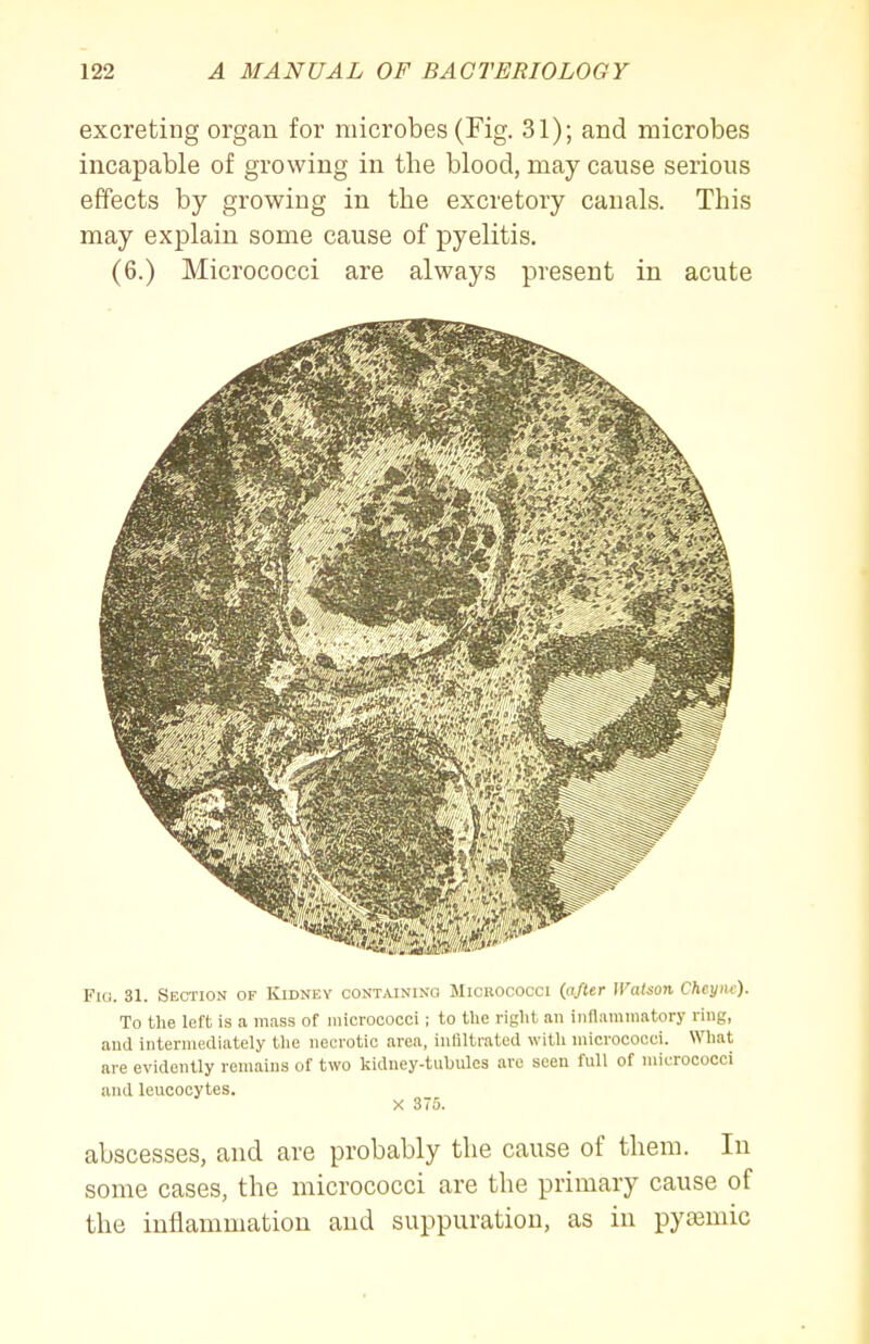 excreting organ for microbes (Fig. 31); and microbes incapable of growing in the blood, may cause serious effects by growing in the excretory canals. This may explain some cause of pyelitis. (6.) Micrococci are always present in acute Fiu. 31. Section of Kidney containing Micrococci {after Watson Cheync). To the left is a mass of micrococci ; to the riglit an inflammatory ring, and intermediately tlie necrotic area, inliltrated witli micrococci. What are evidently remains of two kidney-tubules arc seen full of micrococci and leucocytes. X 375. abscesses, and are probably the cause of them. In some cases, the micrococci are the primary cause of the inflammation and suppuration, as in pysemic