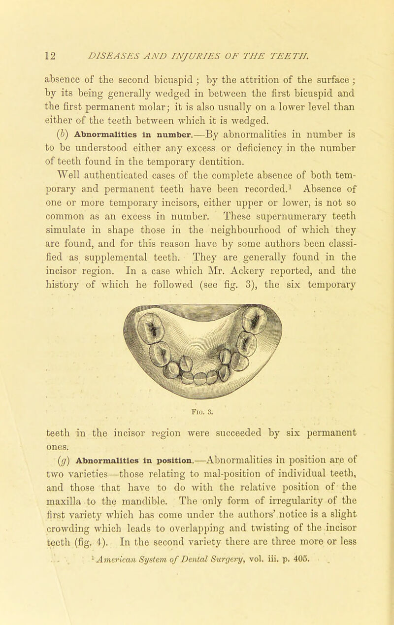 absence of the second bicuspid ; by the attrition of the surface; by its being generally wedged in between the first bicuspid and the first permanent molar; it is also usually on a lower level than either of the teeth between which it is wedged. (b) Abnormalities in number.—By abnormalities in number is to be understood either any excess or deficiency in the number of teeth found in the temporary dentition. Well authenticated cases of the complete absence of both tem- porary and permanent teeth have been recorded.1 Absence of one or more temporary incisors, either upper or lower, is not so common as an excess in number. These supernumerary teeth simulate in shape those in the neighbourhood of which they are found, and for this reason have by some authors been classi- fied as supplemental teeth. They are generally found in the incisor region. In a case which Mr. Ackery reported, and the history of which he followed (see fig. 3), the six temporary Fig. 3. teeth in the incisor region were succeeded by six permanent ones. (y) Abnormalities in position.—Abnormalities in position are of two varieties—those relating to mal-position of individual teeth, and those that have to do with the relative position of the maxilla to the mandible. The only form of irregularity of the first variety which has come under the authors’ notice is a slight crowding which leads to overlapping and twisting of the incisor teeth (fig. 4). In the second variety there are three more or less 1 American System of Dental Surgery, vol. iii. p. 405.