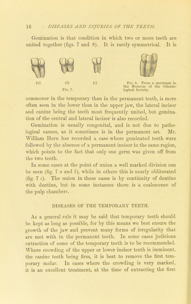 Gemination is that condition in which two or more teeth are united together (figs. 7 and 8). It is rarely symmetrical. It is (a) (b) (c) Fig. 8. From a specimen in the Museum of the Odonto- Fio. 7. logical Society. commoner in the temporary than in the permanent teeth, is more often seen in the lower than in the upper jaw, the lateral incisor and canine being the teeth most frequently united, but gemina- tion of the central and lateral incisor is also recorded. Gemination is usually congenital, and is not due to patho- logical causes, as it sometimes is in the permanent set. Mr. William Hern has recorded a case where geminated teeth were followed by the absence of a permanent incisor in the same region, which points to the fact that only one germ was given off from the two teeth. In some cases at the point of union a well marked division can be seen (fig. 7 a and b), while in others this is nearly obliterated (fig. 7 c). The union in these cases is by continuity of dentine with dentine, but in some instances there is a coalescence of the pulp chambers. DISEASES OF THE TEMPORARY TEETH. As a general rule it may be said that temporary teeth should be kept as long as possible, for by this means we best ensure the growth of the jaw and prevent many forms of irregularity that are met with in the permanent teeth. In some cases judicious extraction of some of the temporary teeth is to be recommended. Where crowding of the upper or lower incisor teeth is imminent, the canine teeth being firm, it is best to remove the first tem- porary molar. In cases where the crowding is very marked, it is an excellent treatment, at the time of extracting the first