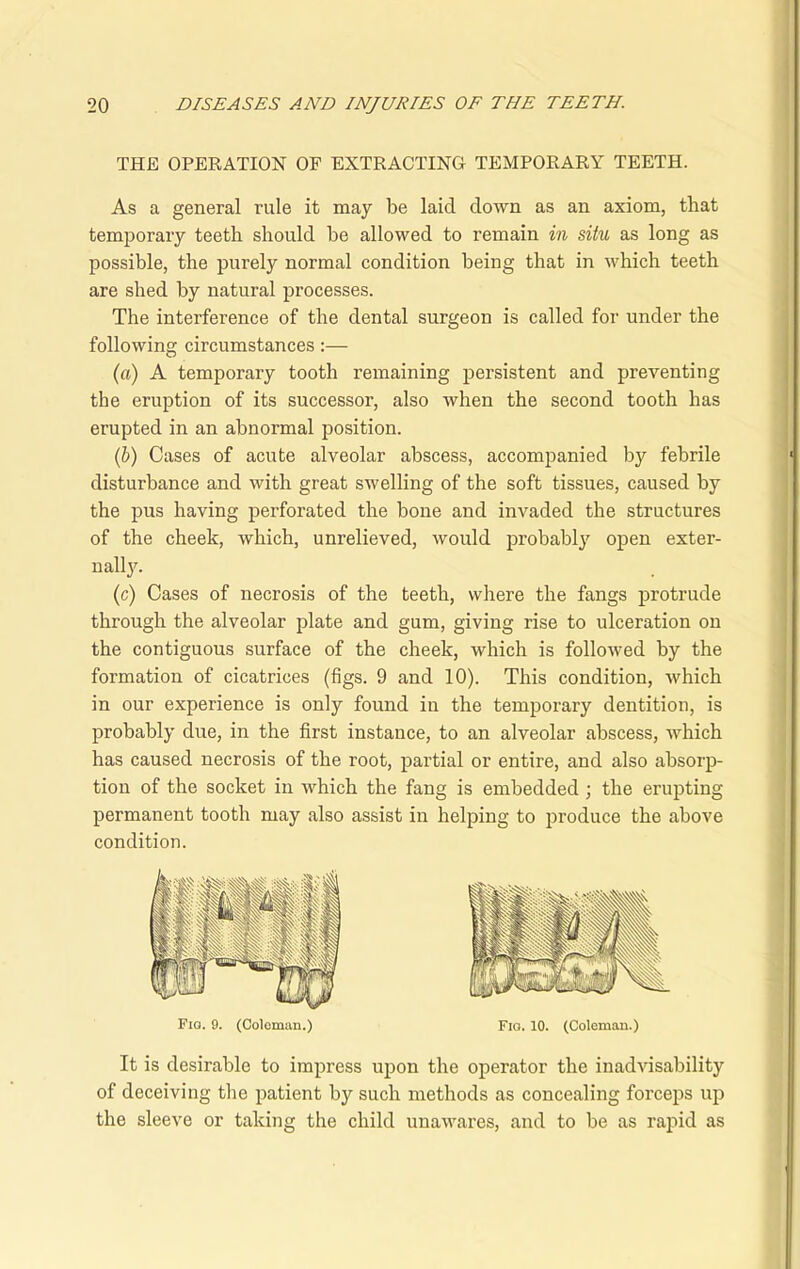 THE OPERATION OF EXTRACTING TEMPORARY TEETH. As a general rule it may be laid down as an axiom, that temporary teeth should he allowed to remain in situ as long as possible, the purely normal condition being that in which teeth are shed by natural processes. The interference of the dental surgeon is called for under the following circumstances:— (a) A temporary tooth remaining persistent and preventing the eruption of its successor, also when the second tooth has erupted in an abnormal position. (b) Cases of acute alveolar abscess, accompanied by febrile disturbance and with great swelling of the soft tissues, caused by the pus having perforated the bone and invaded the structures of the cheek, which, unrelieved, would probably open exter- nally. (c) Cases of necrosis of the teeth, where the fangs protrude through the alveolar plate and gum, giving rise to ulceration on the contiguous surface of the cheek, which is followed by the formation of cicatrices (figs. 9 and 10). This condition, which in our experience is only found in the temporary dentition, is probably due, in the first instance, to an alveolar abscess, which has caused necrosis of the root, partial or entire, and also absorp- tion of the socket in which the fang is embedded ; the erupting permanent tooth may also assist in helping to produce the above condition. Fia. 9. (Coleman.) Fio. 10. (Coleman.) It is desirable to impress upon the operator the inadvisability of deceiving tho patient by such methods as concealing forceps up the sleeve or taking the child unawares, and to be as rapid as