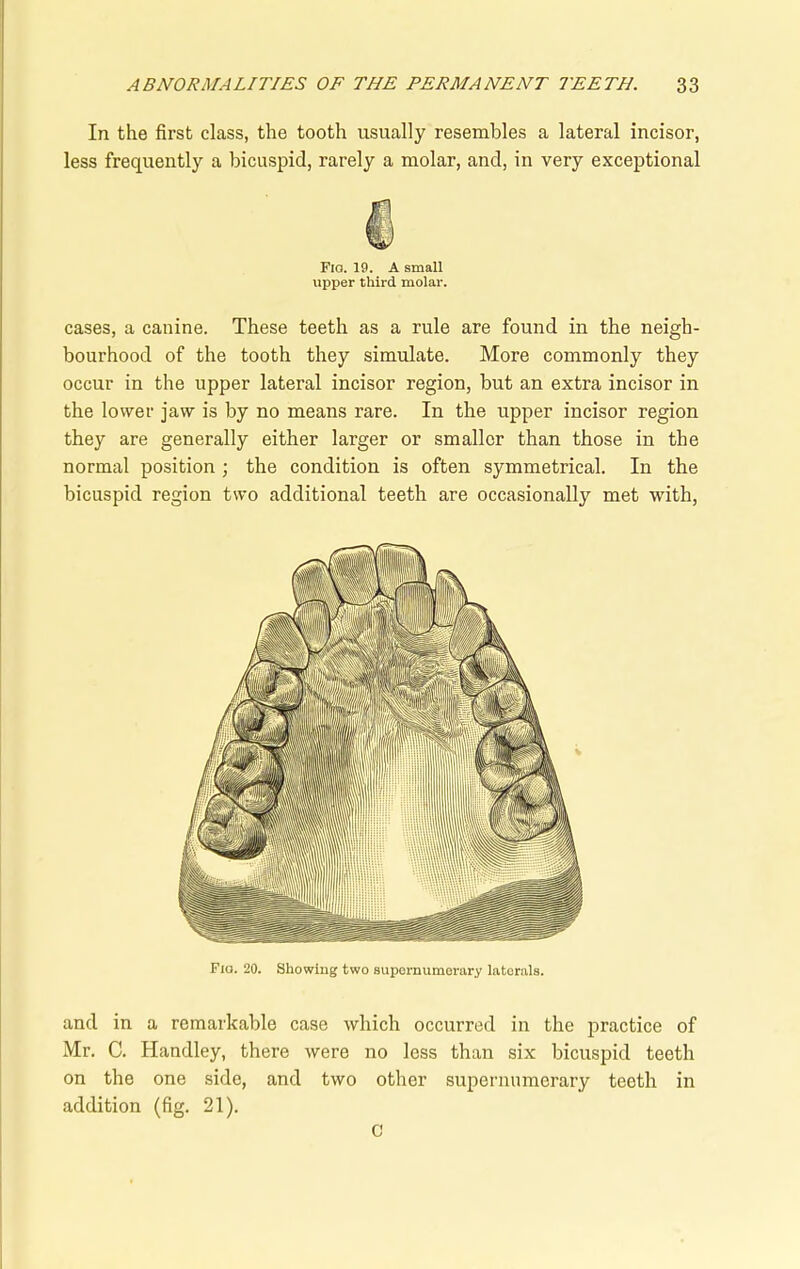 In the first class, the tooth usually resembles a lateral incisor, less frequently a bicuspid, rarely a molar, and, in very exceptional Flo. 19. A small upper third molar. cases, a canine. These teeth as a rule are found in the neigh- bourhood of the tooth they simulate. More commonly they occur in the upper lateral incisor region, but an extra incisor in the lower jaw is by no means rare. In the upper incisor region they are generally either larger or smaller than those in the normal position ; the condition is often symmetrical. In the bicuspid region two additional teeth are occasionally met with, Fio. 20. Showing two supernumerary laterals. and in a remarkable case which occurred in the practice of Mr. C. Handley, there were no less than six bicuspid teeth on the one side, and two other supernumerary teeth in addition (fig. 21). C