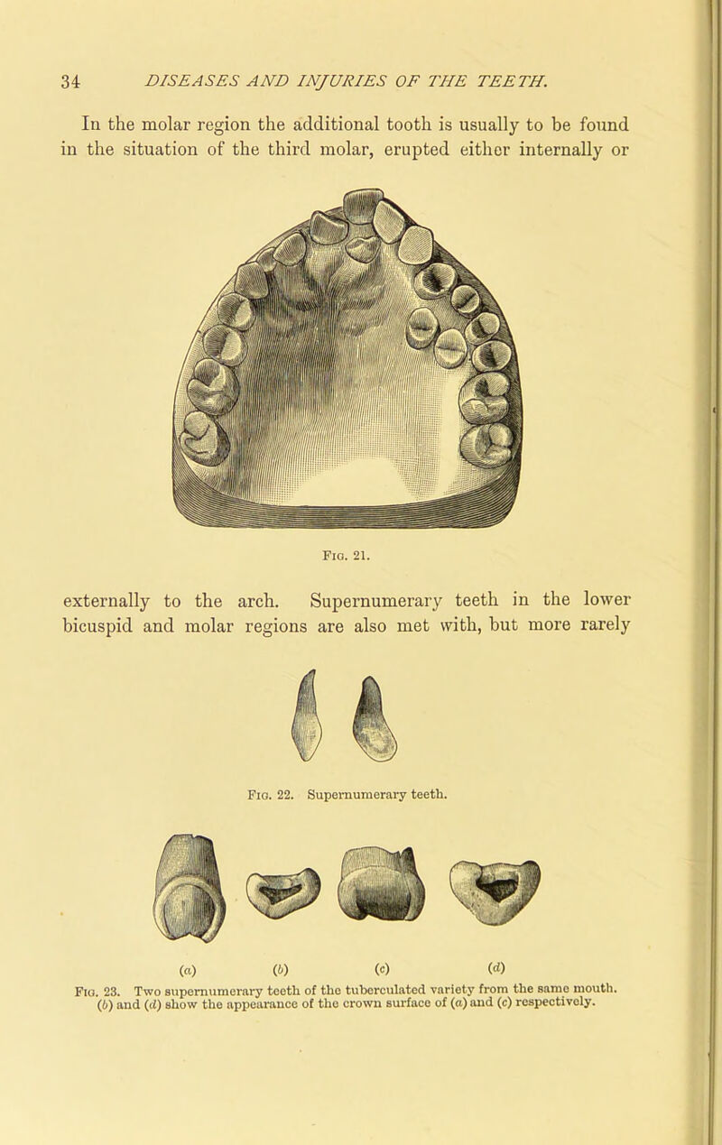 In the molar region the additional tooth is usually to be found in the situation of the third molar, erupted either internally or Fio. 21. externally to the arch. Supernumerary teeth in the lower bicuspid and molar regions are also met with, but more rarely Fio. 22. Supernumerary teeth. (a) (t) W (rf) Fio. 23. Two supernumerary teeth of the tuberculated variety from the same mouth. (b) and (d) show the appearance of the crown surface of (a) and (c) respectively.