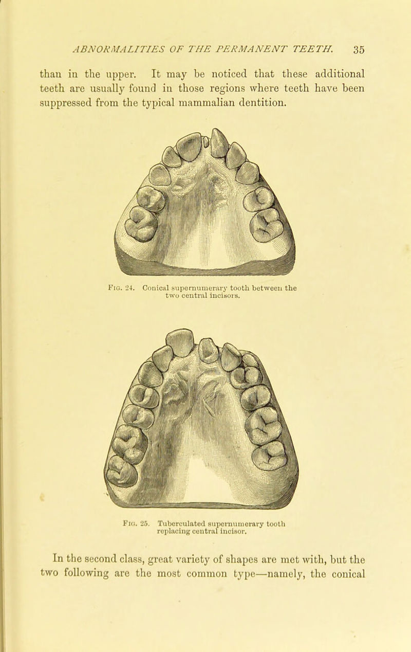 than in the upper. It may be noticed that these additional teeth are usually found in those regions where teeth have been suppressed from the typical mammalian dentition. Fig. 24. Conical supernumerary tooth between the two central incisors. Fio. 25. Tuberculated supernumerary tooth replacing central incisor. In the second class, great variety of shapes are met with, but the two following are the most common type—namely, the conical
