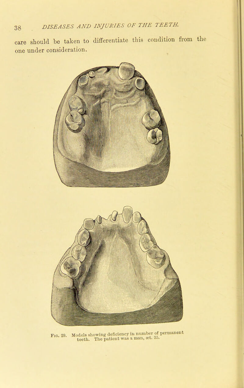 care one DISEASES AND INJURIES OF THE TEETH. should be taken to differentiate this condition from the under consideration. FlO. 29. Models showing deficiency in number of permanent teeth. The patient was a man, rot. do.