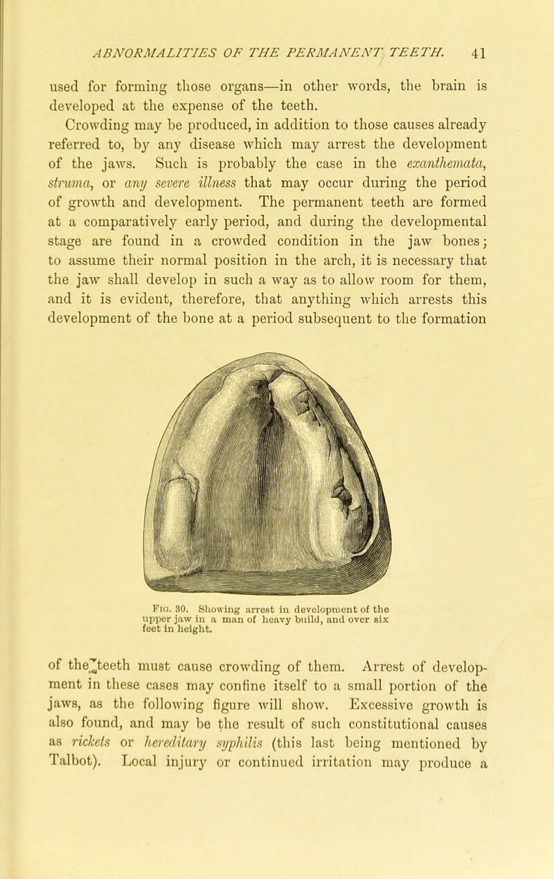 used for forming those organs—in other words, the brain is developed at the expense of the teeth. Crowding may be produced, in addition to those causes already referred to, by any disease which may arrest the development of the jaws. Such is probably the case in the exanthemata, struma, or any severe illness that may occur during the period of growth and development. The permanent teeth are formed at a comparatively early period, and during the developmental stage are found in a crowded condition in the jaw bones; to assume their normal position in the arch, it is necessary that the jaw shall develop in such a way as to allow room for them, and it is evident, therefore, that anything which arrests this development of the bone at a period subsequent to the formation Fio. 30. Showing arrest in development of the upper jaw in a man of heavy build, and over six feet in height. °f the^teeth must cause crowding of them. Arrest of develop- ment in these cases may confine itself to a small portion of the jaws, as the following figure will show. Excessive growth is also found, and may be the result of such constitutional causes as rickets or hereditary syphilis (this last being mentioned by Talbot). Local injury or continued irritation may produce a