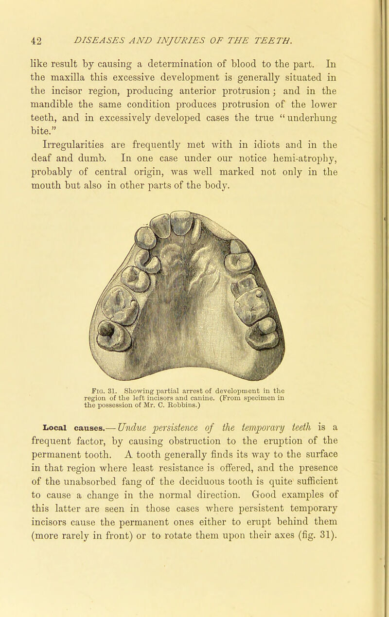 like result by causing a determination of blood to the part. In the maxilla this excessive development is generally situated in the incisor region, producing anterior protrusion; and in the mandible the same condition produces protrusion of the lower teeth, and in excessively developed cases the true “ underhung bite.” Irregularities are frequently met with in idiots and in the deaf and dumb. In one case under our notice hemi-atrophy, probably of central origin, was well marked not only in the mouth but also in other parts of the bod}r. Fig. 31. Showing partial arrest of development in the region of the left incisors and canine. (From specimen in the possession of Mr. C. Bobbins.) Local causes.— Undue persistence of the temporary teeth is a frequent factor, by causing obstruction to the eruption of the permanent tooth. A tooth generally finds its way to the surface in that region where least resistance is offered, and the presence of the unabsorbed fang of the deciduous tooth is quite sufficient to cause a change in the normal direction. Good examples of this latter are seen in those cases where persistent temporary incisors cause the permanent ones either to erupt behind them (more rarely in front) or to rotate them upon their axes (fig. 31).