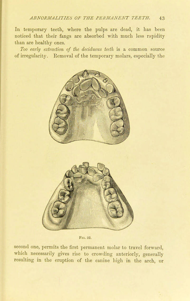 In temporary teeth, where the pulps are dead, it has been noticed that their fangs are absorbed with much less rapidity than are healthy ones. Too early extraction of the deciduous teeth is a common source of irregularity. Removal of the temporary molars, especially the Fig. 82. second one, permits the first permanent molar to travel forward, which necessarily gives rise to crowding anteriorly, generally resulting in the eruption of the canine high in the arch, or