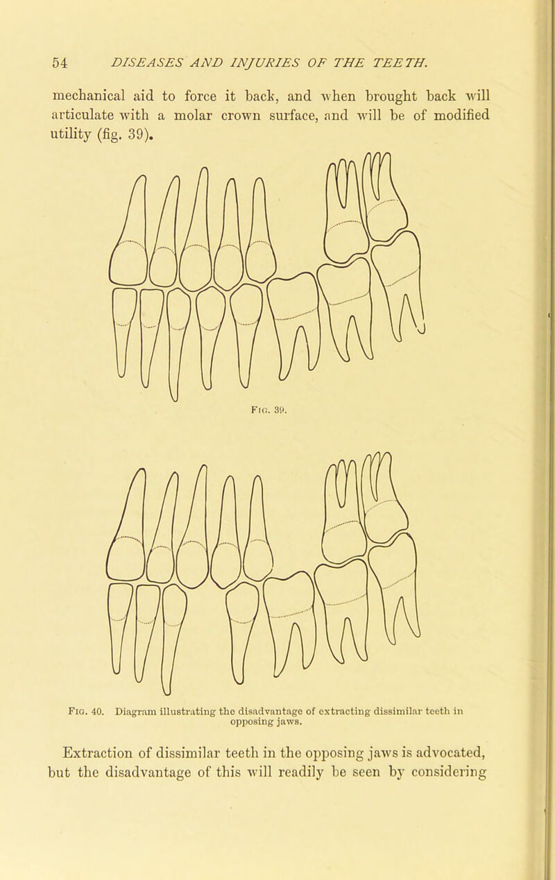 mechanical aid to force it bach, and when brought hack will articulate with a molar crown surface, and will be of modified utility (fig. 39). Fig. 40. Diagram illustrating tlic disadvantage of extracting dissimilar teeth in opposing jaws. Extraction of dissimilar teeth in the opposing jaws is advocated, but the disadvantage of this will readily he seen by considering