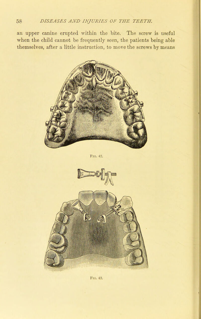 an upper canine erupted within the bite. The screw is useful when the child cannot be frequently seen, the patients being able themselves, after a little instruction, to move the screws by means Fra. 43.