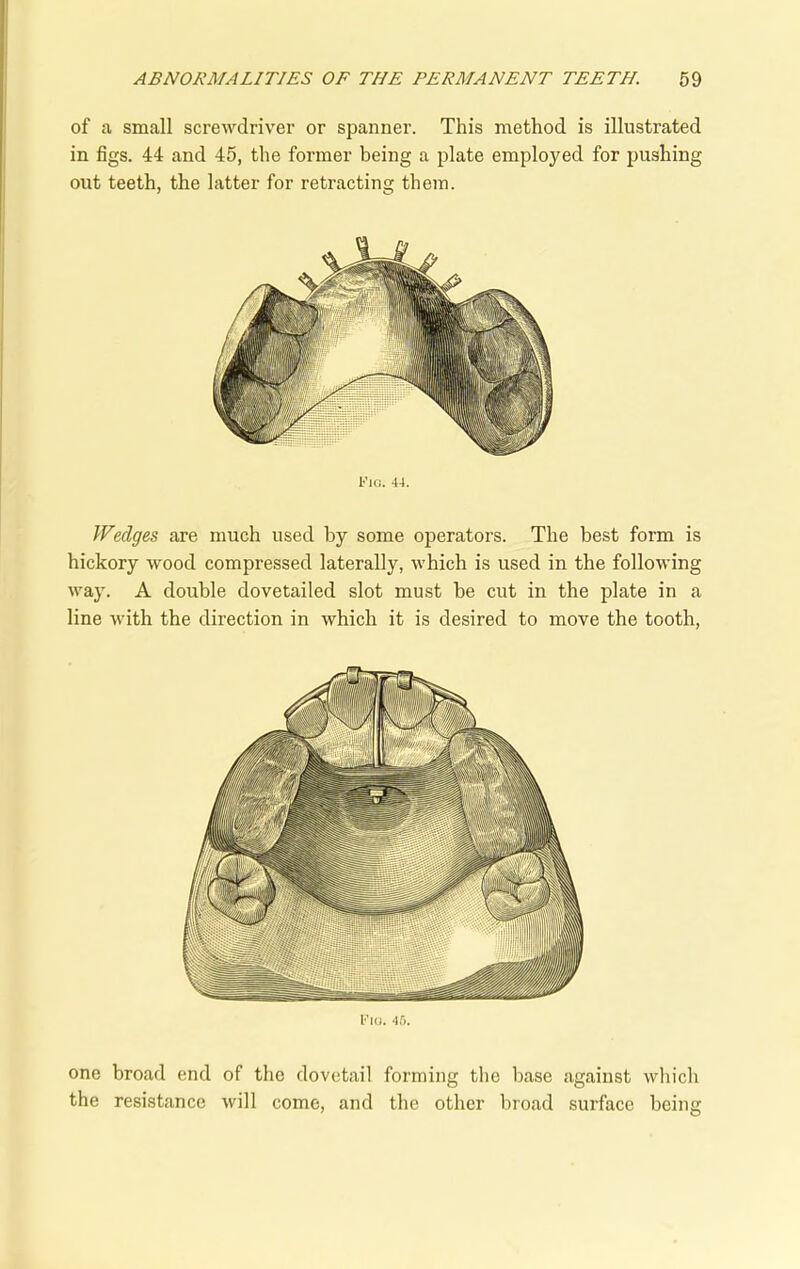 of a small screwdriver or spanner. This method is illustrated in figs. 44 and 45, the former being a plate employed for pushing out teeth, the latter for retracting them. Fig. 44. Wedges are much used by some operators. The best form is hickory wood compressed laterally, which is used in the following way. A double dovetailed slot must be cut in the plate in a line with the direction in which it is desired to move the tooth, Fig. 45. one broad end of the dovetail forming the base against which the resistance will come, and the other broad surface being