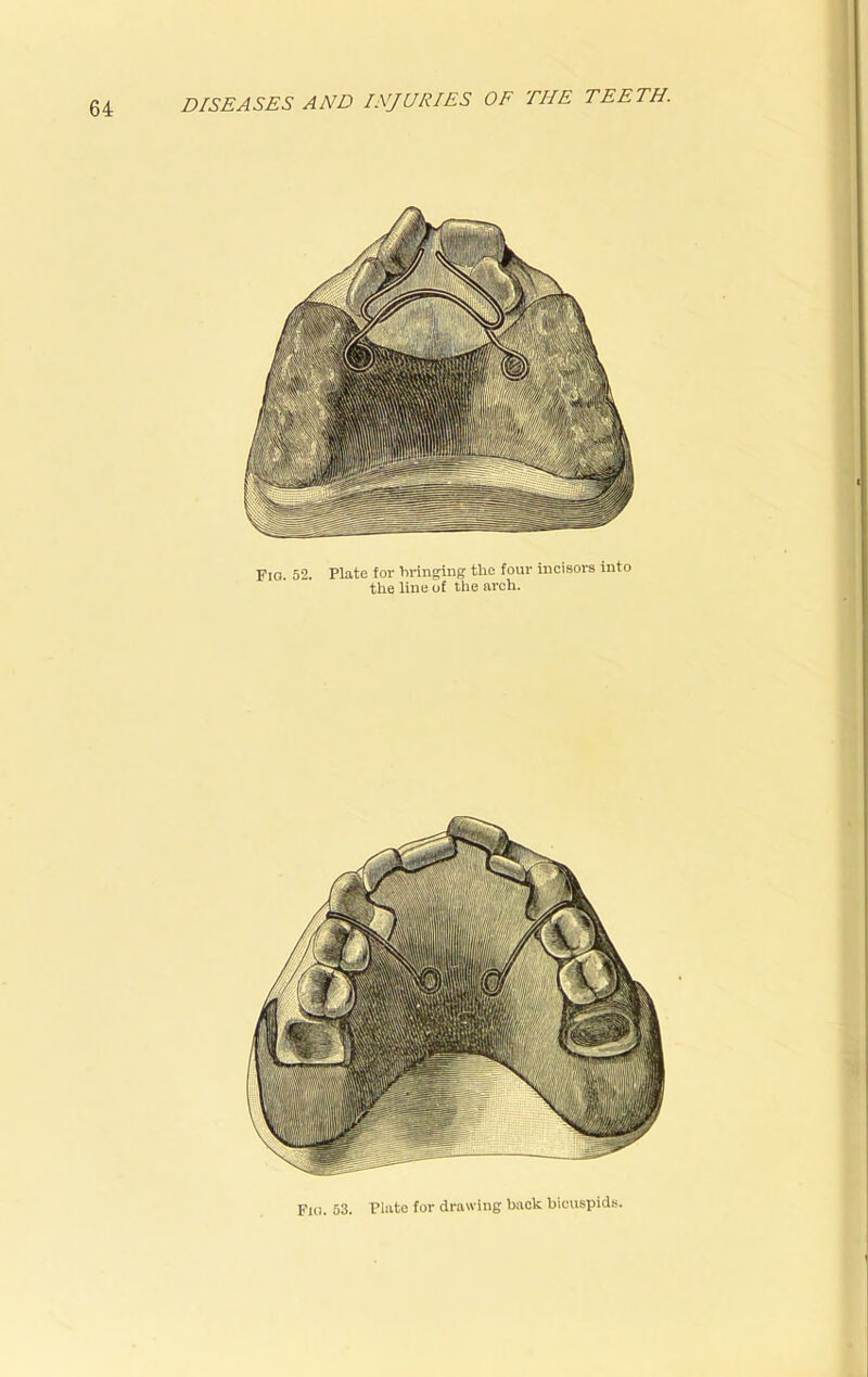 Fia. 52. Plate for bringing tire four incisors into the line of the arch. Fig. 53. Plate for drawing back bicuspids.