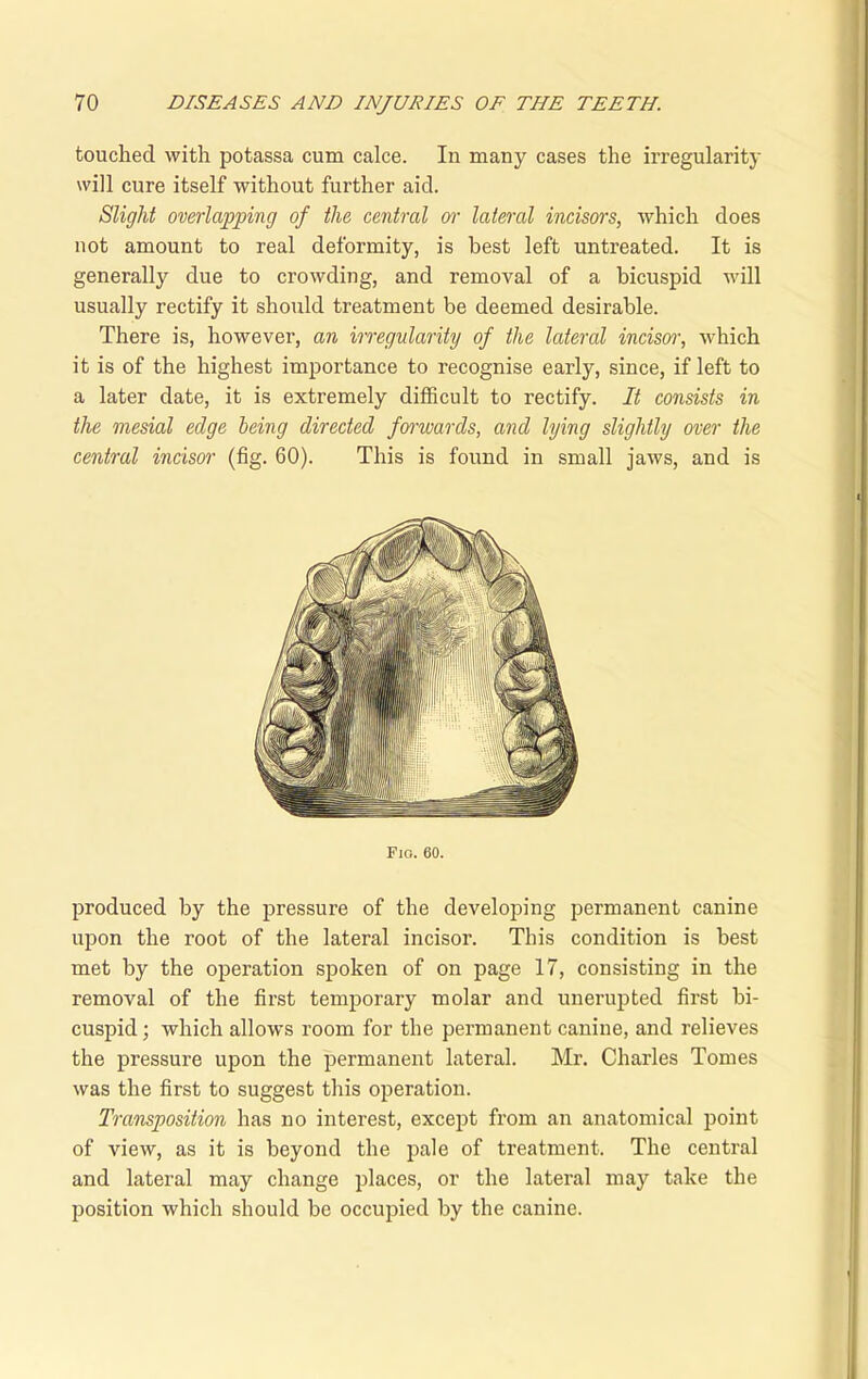 touched with potassa cum calce. In many cases the irregularity will cure itself without further aid. Slight overlapping of the central err lateral incisors, which does not amount to real deformity, is best left untreated. It is generally due to crowding, and removal of a bicuspid will usually rectify it should treatment be deemed desirable. There is, however, an irregularity of the lateral inciserr, which it is of the highest importance to recognise early, since, if left to a later date, it is extremely difficult to rectify. It consists in the mesial edge being directed forwards, and lying slightly over the central incisor (fig. 60). This is found in small jaws, and is Fig. 60. produced by the pressure of the developing permanent canine upon the root of the lateral incisor. This condition is best met by the operation spoken of on page 17, consisting in the removal of the first temporary molar and unerupted first bi- cuspid ; which allows room for the permanent canine, and relieves the pressure upon the permanent lateral. Mr. Charles Tomes was the first to suggest this operation. Transposition has no interest, except from an anatomical point of view, as it is beyond the pale of treatment. The central and lateral may change places, or the lateral may take the position which should be occupied by the canine.