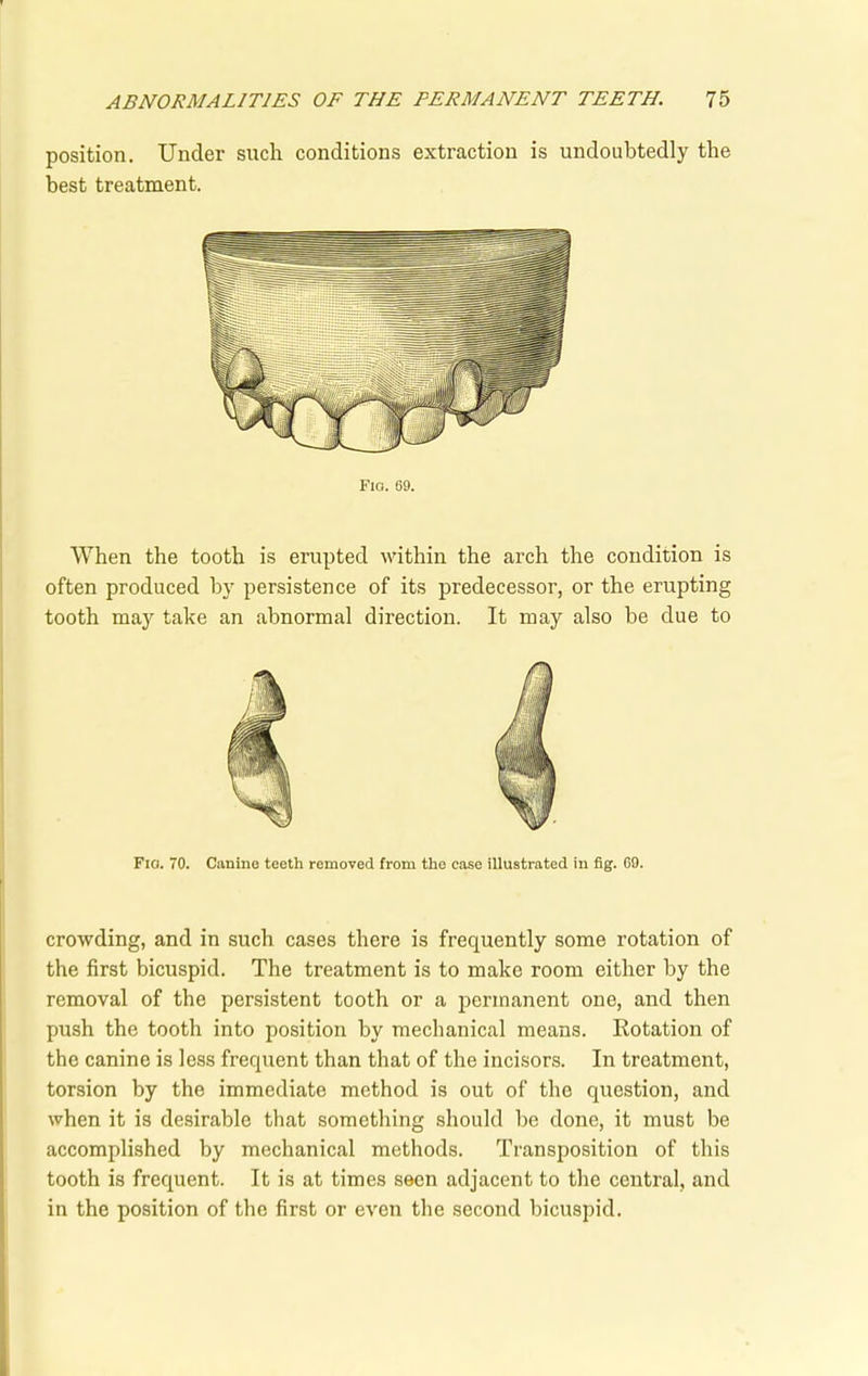 position. Under such, conditions extraction is undoubtedly the best treatment. Flo. 69. When the tooth is erupted within the arch the condition is often produced by persistence of its predecessor, or the erupting tooth may take an abnormal direction. It may also be due to Fia. 70. Canine teeth removed from the case illustrated in fig. GO. crowding, and in such cases there is frequently some rotation of the first bicuspid. The treatment is to make room either by the removal of the persistent tooth or a permanent one, and then push the tooth into position by mechanical means. Rotation of the canine is less frequent than that of the incisors. In treatment, torsion by the immediate method is out of the question, and when it is desirable that something should be done, it must be accomplished by mechanical methods. Transposition of this tooth is frequent. It is at times seen adjacent to the central, and in the position of the first or even the second bicuspid.
