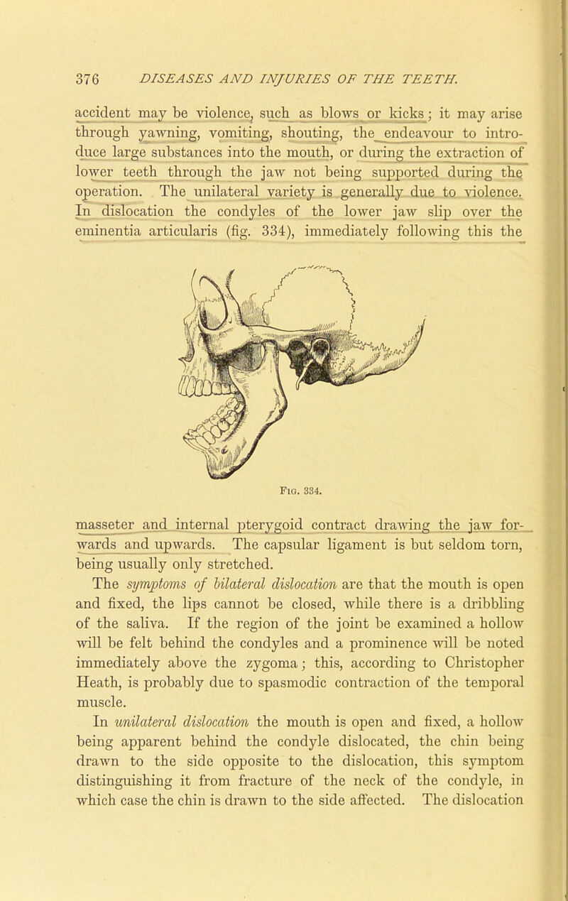 accident may be violence^ such as blows or kicks; it may arise through yawning, vomiting, shouting, the endeavour to intro- duce large substances into the mouth, or during the extraction of lower teeth through the jaw not being supported during the operation. The unilateral variety is generally due to violence, In dislocation the condyles of the lower jaw slip over the eminentia articularis (fig. 334), immediately following this the Fio. 334. masseter and internal pterygoid contract drawing the jaw for-, wards and upwards. The capsular ligament is but seldom torn, being usually only stretched. The symptoms of bilateral dislocation are that the mouth is open and fixed, the lips cannot be closed, while there is a dribbling of the saliva. If the region of the joint be examined a hollow will be felt behind the condyles and a prominence will be noted immediately above the zygoma; this, according to Christopher Heath, is probably due to spasmodic contraction of the temporal muscle. In unilateral dislocation the mouth is open and fixed, a hollow being apparent behind the condyle dislocated, the chin being drawn to the side opposite to the dislocation, this symptom distinguishing it from fracture of the neck of the condyle, in which case the chin is drawn to the side affected. The dislocation