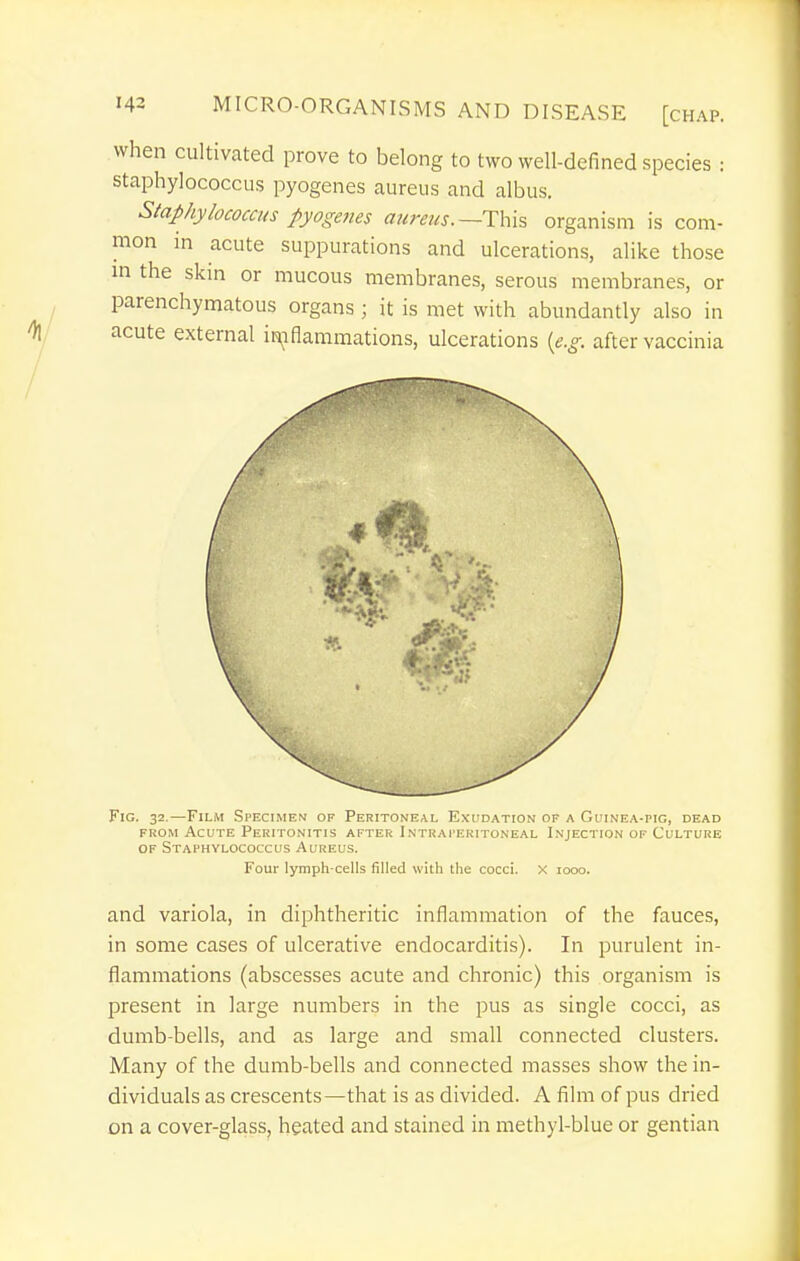when cultivated prove to belong to two well-defined species : staphylococcus pyogenes aureus and albus. Staphylococcus pyogenes aureus. organism is com- mon in acute suppurations and ulcerations, alike those in the skin or mucous membranes, serous membranes, or parenchymatous organs ; it is met with abundantly also in acute external ir\iflammations, ulcerations {e.g. after vaccinia Fig. 32.—Film Specimen op Peritoneal Exudation of a Guinea-pig, dead FROM Acute Peritonitis after Intraperitoneal Injection of Culture OF Staphylococcus Aureus. Four lymph-cells filled with the cocci. X 1000. and variola, in diphtheritic inflammation of the fauces, in some cases of ulcerative endocarditis). In purulent in- flammations (abscesses acute and chronic) this organism is present in large numbers in the pus as single cocci, as dumb-bells, and as large and small connected clusters. Many of the dumb-bells and connected masses show the in- dividuals as crescents—that is as divided. A film of pus dried on a cover-glass, heated and stained in methyl-blue or gentian