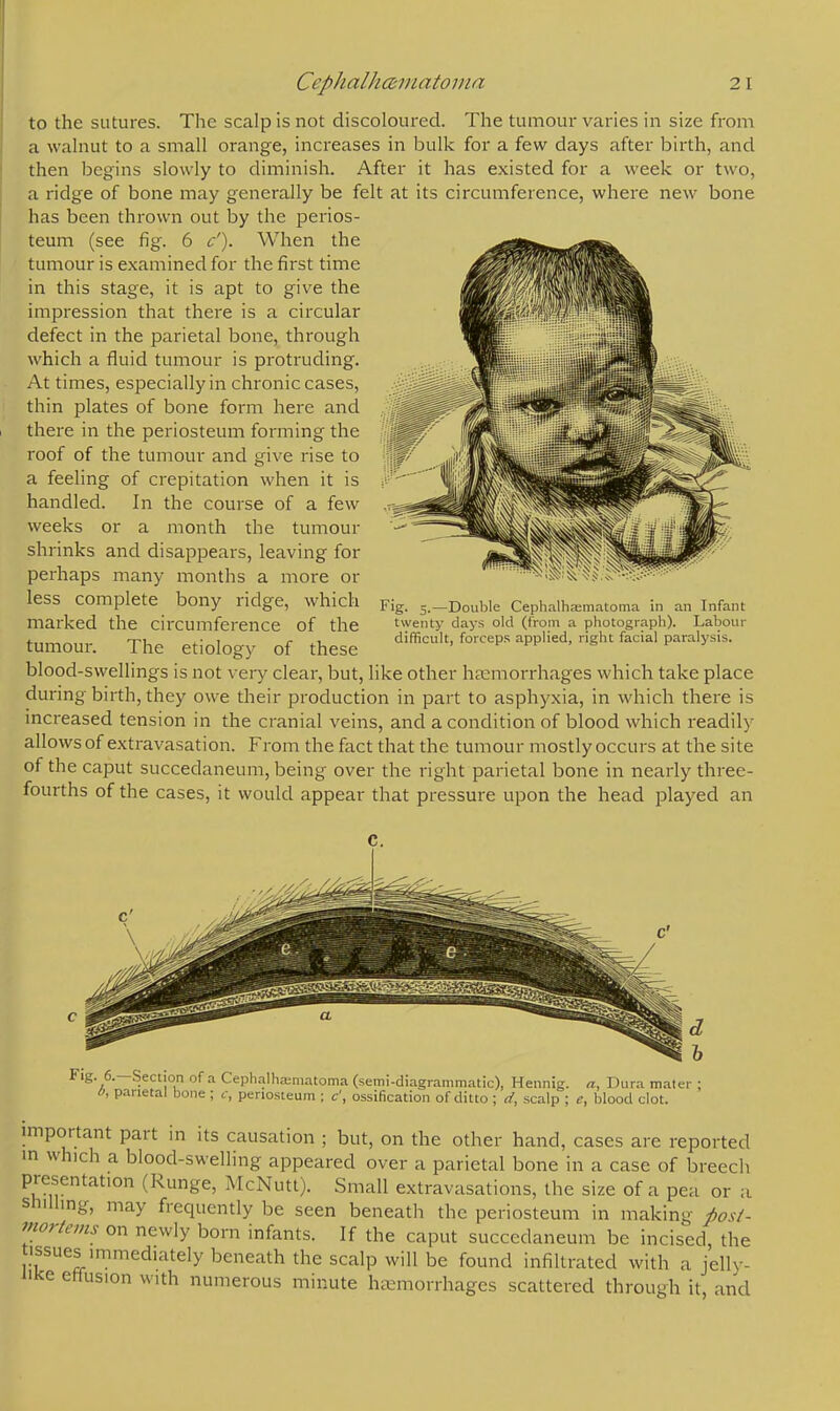 to the sutures. The scalp is not discoloured. The tumour varies in size from a walnut to a small orange, increases in bulk for a few days after birth, and then begins slowly to diminish. After it has existed for a week or two, a ridge of bone may generally be felt at its circumference, where new bone has been thrown out by the perios- teum (see fig. 6 c'). When the tumour is examined for the first time in this stage, it is apt to give the impression that there is a circular defect in the parietal bone, through which a fluid tumour is protruding. At times, especially in chronic cases, thin plates of bone form here and there in the periosteum forming the roof of the tumour and give rise to a feeling of crepitation when it is handled. In the course of a few weeks or a month the tumour shrinks and disappears, leaving for perhaps many months a more or less complete bony ridge, which marked the circumference of the tumour. The etiology of these blood-swellings is not very clear, but, like other hemorrhages which take place during birth, they owe their production in part to asphyxia, in which there is increased tension in the cranial veins, and a condition of blood which readily allows of extravasation. From the fact that the tumour mostly occurs at the site of the caput succedaneum, being over the right parietal bone in nearly three- fourths of the cases, it would appear that pressure upon the head played an Fig. 5.—Double Cephalhematoma in an Infant twenty days old (from a photograph). Labour difficult, forceps applied, right facial paralysis. Fig. 6.—Section of a Cephalhematoma (semi-diagrammatic), Hennig. a, Dura mater ; 0, parietal bone ; c, periosteum ; c\ ossification of ditto ; d, scalp ; e, blood clot. important part in its causation ; but, on the other hand, cases are reported in which a blood-swelling appeared over a parietal bone in a case of breech presentation (Runge, McNutt). Small extravasations, the size of a pea or a shilling, may frequently be seen beneath the periosteum in making post- mortems on newly born infants. If the caput succedaneum be incised, the tissues immediately beneath the scalp will be found infiltrated with a jelly- iike effusion with numerous minute haemorrhages scattered through it, and