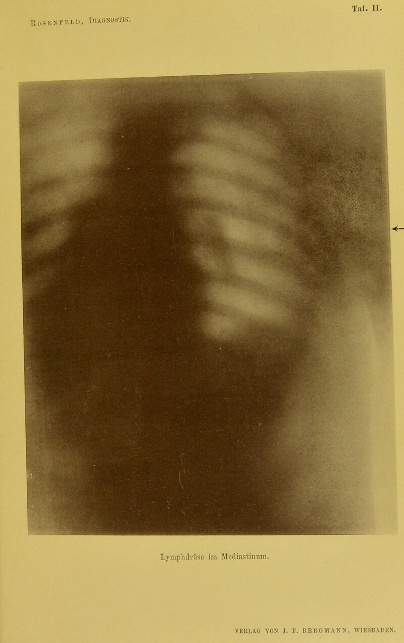 Rosenfeld, Diagnostik. Lymphdrüse im Mediastinum.