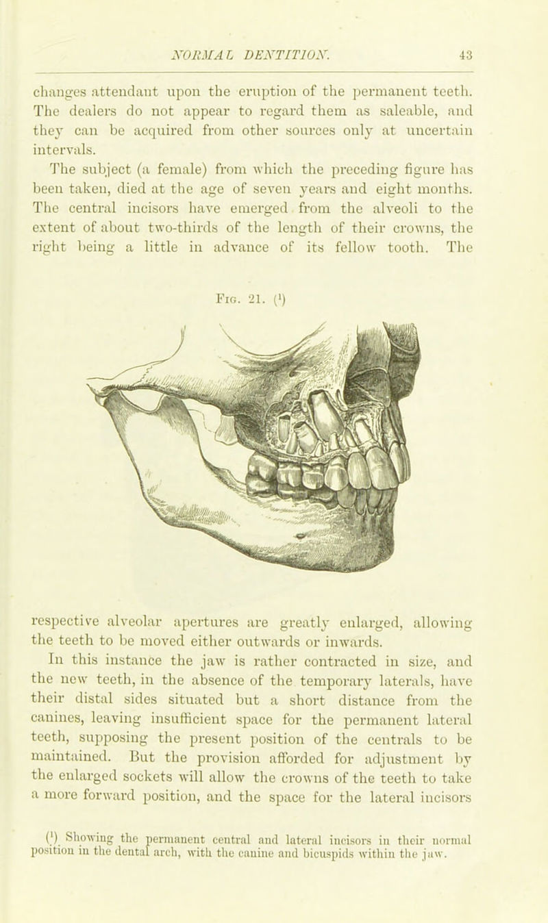 changes attendant upon the eruption of the permanent teeth. The dealers do not appear to regard them as saleable, and they can be acquired from other sources only at uncertain intervals. The subject (a female) from which the preceding figure has been taken, died at the age of seven years and eight months. The central incisors have emerged from the alveoli to the extent of about two-thirds of the length of their crowns, the right being a little in advance of its fellow tooth. The Fig. 21. (*) respective alveolar apertures are greatly enlarged, allowing the teeth to be moved either outwards or inwards. In this instance the jaw is rather contracted in size, and the new teeth, in the absence of the temporary laterals, have their distal sides situated but a short distance from the canines, leaving insufficient space for the permanent lateral teeth, supposing the present position of the centrals to be maintained. But the provision afforded for adjustment by the enlarged sockets will allow the crowns of the teeth to take a more forward position, and the space for the lateral incisors (.'). Showing the permanent central and lateral incisors in their normal position in the dental arch, with the canine and bicuspids within the jaw.