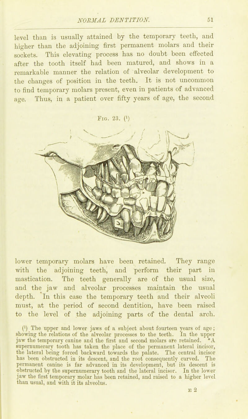 level than is usually attained by the temporary teeth, and higher than the adjoining first permanent molars and their sockets. This elevating process has no doubt been effected after the tooth itself had been matured, and shows in a remarkable manner the relation of alveolar development to the changes of position in the teeth. It is not uncommon to find temporary molars present, even in patients of advanced age. Thus, in a patient over fifty years of age, the second Fig. 23. (>) lower temporary molars have been retained. They range with the adjoining teeth, and perform their part in mastication. The teeth generally are of the usual size, and the jaw and alveolar processes maintain the usual depth. In this case the temporary teeth and their alveoli must, at the period of second dentition, have been raised to the level of the adjoining parts of the dental arch. (') The upper and lower jaws of a subject about fourteen years of age; showing the relations of the alveolar processes to the teeth. In the upper jaw the temporary canine and the first aud second molars are retained. *A supernumerary tooth has taken the place of the permanent lateral incisor, the lateral being forced backward towards the palate. The central incisor has been obstructed in its descent, and the root consequently curved. The permanent canine is far advanced in its development, hut its descent is obstructed by the supernumerary tooth and the lateral incisor. In the lower jaw the first temporary molar has been retained, and raised to a higher level than usual, and with it its alveolus. E 2