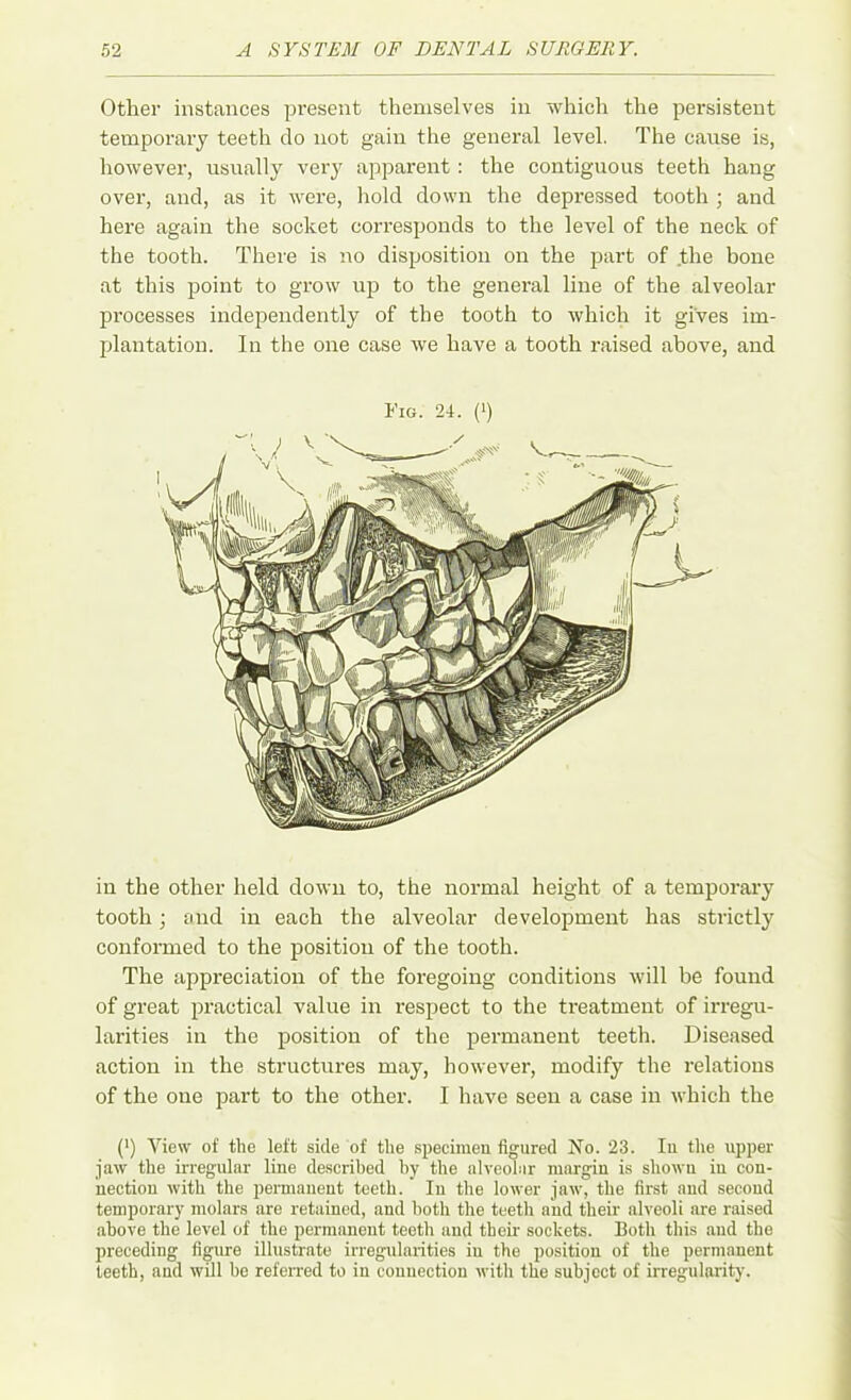 Other instances present themselves in which the persistent temporary teeth do not gain the general level. The cause is, however, usually very apparent : the contiguous teeth hang over, and, as it were, hold down the depressed tooth ; and here again the socket corresponds to the level of the neck of the tooth. There is no disposition on the part of the bone at this point to grow up to the general line of the alveolar processes independently of the tooth to which it gives im- plantation. In the one case we have a tooth raised above, and Fig. 24. (>) in the other held down to, the normal height of a temporary tooth ; and in each the alveolar development has strictly conformed to the position of the tooth. The appreciation of the foregoing conditions will be found of great practical value in respect to the treatment of irregu- larities in the position of the permanent teeth. Diseased action in the structures may, however, modify the relations of the one part to the other. I have seen a case in which the (*) (*) View of the left side of the specimen figured No. 23. In the upper jaw the irregular line described hy the alveolar margin is shown iu con- nection with the permanent teeth. In the lower jaw, the first and second temporary molars are retained, and both the teeth and their alveoli are raised above the level of the permanent teeth and their sockets. Both this and the preceding figure illustrate irregularities iu the position of the permanent teeth, and will he referred to in connection with the subject of irregularity.