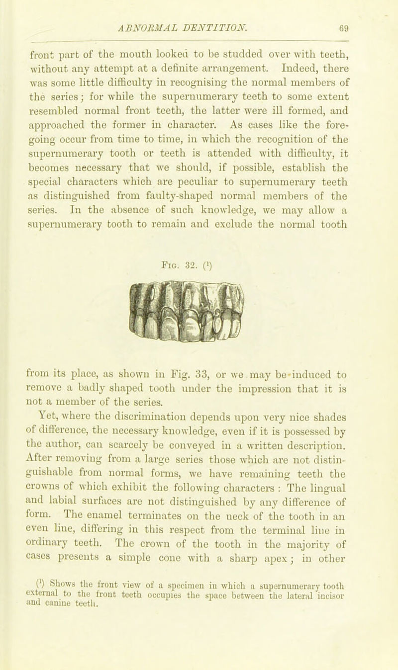 front part of the mouth looked to be studded over with teeth, without any attempt at a definite arrangement. Indeed, there was some little difficulty in recognising the normal members of the series; for while the supernumerary teeth to some extent resembled normal front teeth, the latter were ill formed, and approached the former in character. As cases like the fore- going occur from time to time, in which the recognition of the supernumerary tooth or teeth is attended with difficulty, it becomes necessary that we should, if possible, establish the special characters which are peculiar to supernumerary teeth as distinguished from faulty-shaped normal members of the series. In the absence of such knowledge, we may allow a supernumerary tooth to remain and exclude the normal tooth Fig. 32. (') from its place, as shown in Fig. 33, or we may be-induced to remove a badly shaped tooth under the impression that it is not a member of the series. Yet, where the discrimination depends upon very nice shades of difference, the necessary knowledge, even if it is possessed by the author, can scarcely be conveyed in a written description. After removing from a large series those which are not distin- guishable from normal forms, we have remaining teeth the crowns of which exhibit the following characters : The lingual and labial surfaces are not distinguished by any difference of form. The enamel terminates on the neck of the tooth in an even line, differing in this respect from the terminal line in ordinary teeth. The crown of the tooth in the majority of cases presents a simple cone with a sharp apex; in other (*) (*) Shows the front view of a specimen in which a supernumerary tooth external to the front teeth occupies the siiace between the lateral incisor anil canine teeth.