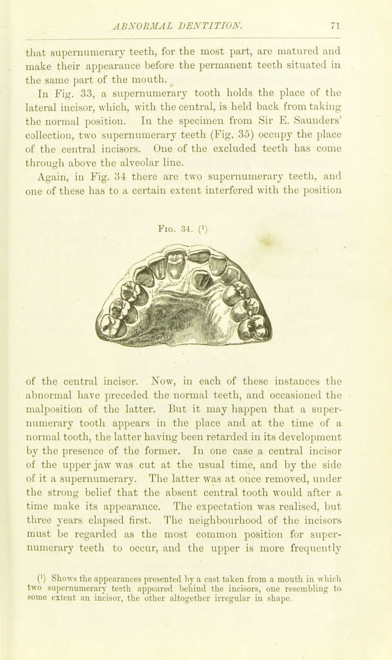 that supernumerary teeth, for the most part, are matured and make their appearance before the permanent teeth situated in the same part of the mouth. In Fig. 33, a supernumerary tooth holds the place of the lateral incisor, which, with the central, is held back from taking the normal position. In the specimen from Sir E. Saunders’ collection, two supernumerary teeth (Fig. 35) occupy the place of the central incisors. One of the excluded teeth has come through above the alveolar line. Again, in Fig. 34 there are two supernumerary teeth, and one of these has to a certain extent interfered with the position Fig. 34. (') of the central incisor. Now, in each of these instances the abnormal have preceded the normal teeth, and occasioned the malposition of the latter. But it may happen that a super- numerary tooth appears in the place and at the time of a normal tooth, the latter having been retarded in its development by the presence of the former. In one case a central incisor of the upper jaw was cut at the usual time, and by the side of it a supernumerary. The latter was at once removed, under the strong belief that the absent central tooth would after a time make its appearance. The expectation was realised, but three years elapsed first. The neighbourhood of the incisors must be regarded as the most common position for super- numerary teeth to occur, and the upper is more frequently (') Shows the appearances presented by a east taken from a mouth in which two supernumerary teeth appeared behind the incisors, one resembling to some extent an incisor, the other altogether irregular in shape.