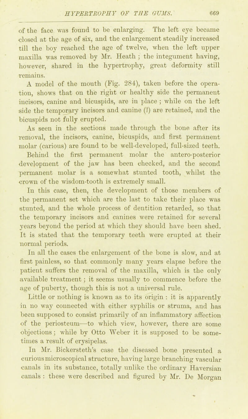 of the face was found to be enlarging. The left eye became ■closed at the age of six, and the enlargement steadily increased till the boy reached the age of twelve, when the left upper maxilla was removed by Mr. Heath ; the integument having, however, shared in the hypertrophy, great deformity still remains. A model of the mouth (Fig. 284), taken before the opera- tion, shows that on the right or healthy side the permanent incisors, canine and bicuspids, are in place ; while on the left side the temporary incisors and canine (?) are retained, and the bicuspids not fully erupted. As seen in the sections made through the bone after its removal, the incisors, canine, bicuspids, and first permanent molar (carious) are found to be well-developed, full-sized teeth. Behind the first permanent molar the antero-posterior development of the jaw has been checked, and the second permanent molar is a somewhat stunted tooth, whilst the crown of the wisdom-tooth is extremely small. In this case, then, the development of those members of the permanent set which are the last to take their place was stunted, and the whole process of dentition retarded, so that the temporary incisors and canines were retained for several years beyond the period at which they should have been shed. It is stated that the temporary teeth were erupted at their normal periods. In all the cases the enlargement of the bone is slow, and at first painless, so that commonly many years elapse before the patient suffers the removal of the maxilla, which is the only available treatment; it seems usually to commence before the age of puberty, though this is not a universal rule. Little or nothing is known as to its origin : it is apparently in no way connected with either syphilis or struma, and has been supposed to consist primarily of an inflammatory affection of the periosteum—to which view, however, there are some objections; while by Otto Weber it is supposed to be some- times a result of erysipelas. In Mr. Bickersteth’s case the diseased bone presented a curious microscopical structure, having large branching vascular canals in its substance, totally unlike the ordinary Haversian canals : these were described and figured by Mr. De Morgan