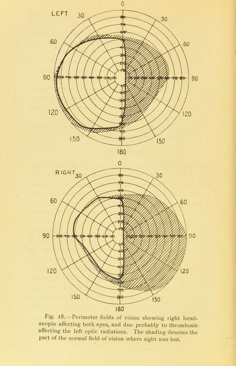 0 0 180 Fig. 18.—Perimeter fields of vision showing right hemi- anopia affecting both eyes, and due probably to thrombosis affecting the left optic radiations. The shading denotes the part of the normal field of vision where sight was lost.