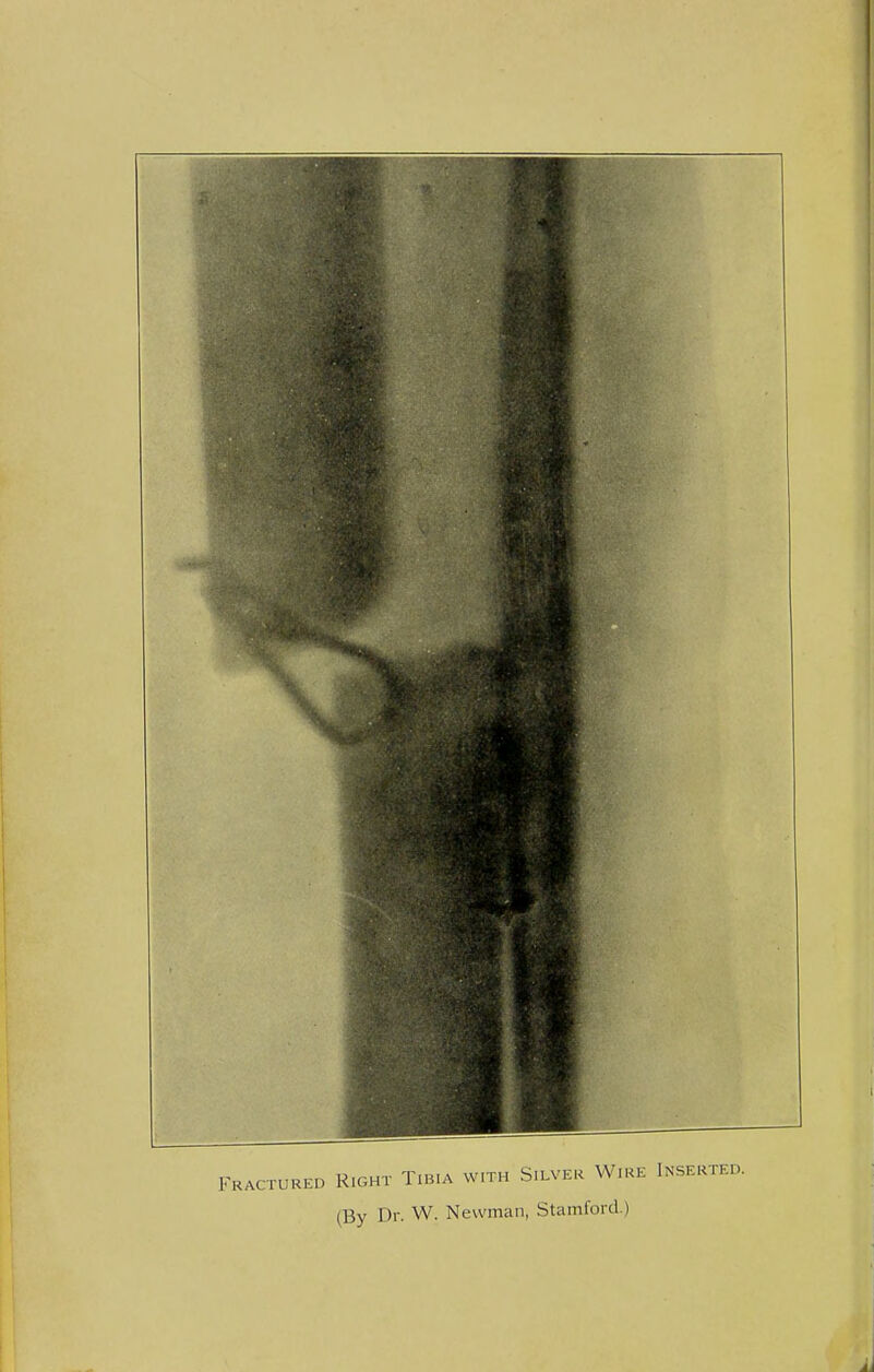 Fractured Right Tibia with Silver Wire Inserted. (By Dr. W. Newman, Stamford.)