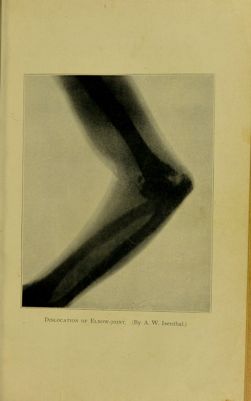 tion of Elbow-joint. (By A. W. Isenthal.)